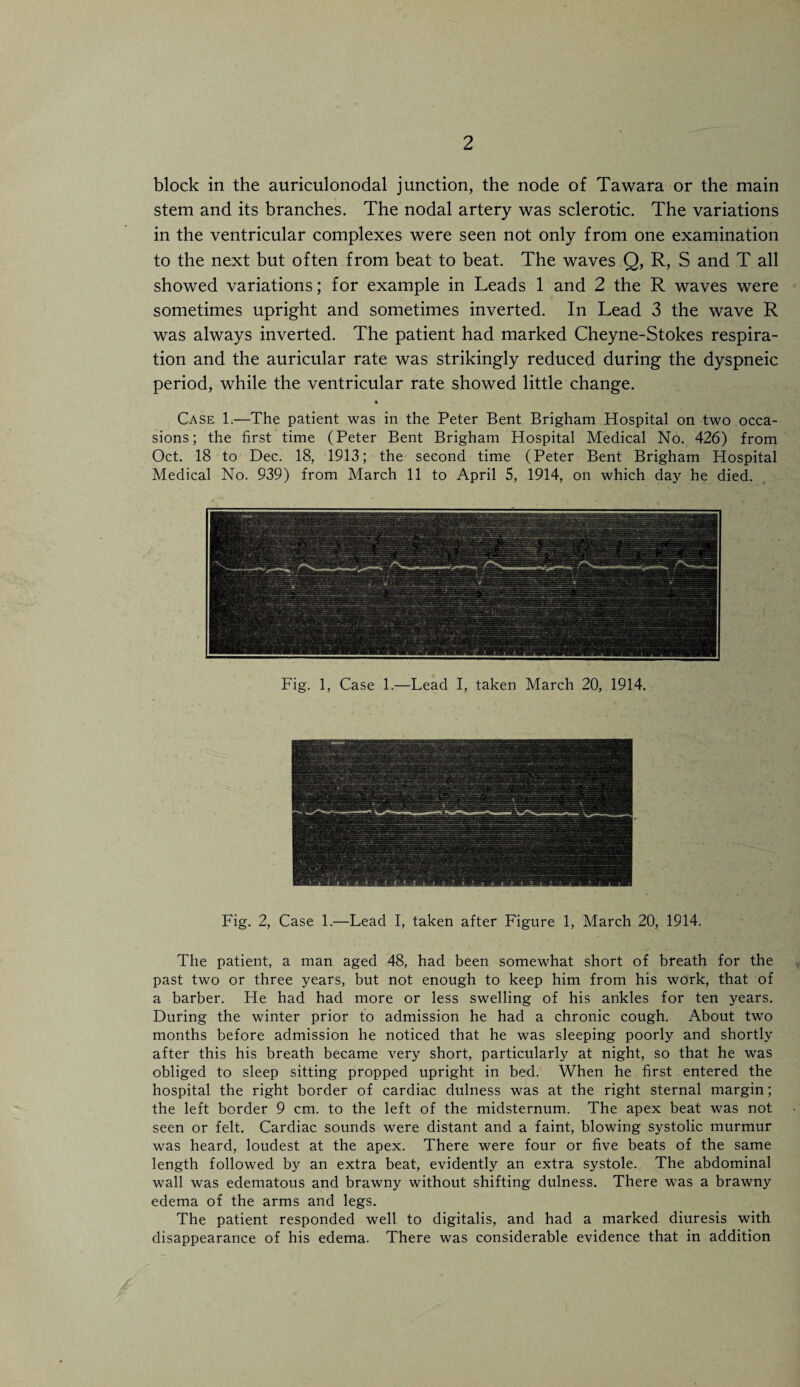 block in the auriculonodal junction, the node of Tawara or the main stem and its branches. The nodal artery was sclerotic. The variations in the ventricular complexes were seen not only from one examination to the next but often from beat to beat. The waves Q, R, S and T all showed variations; for example in Leads 1 and 2 the R waves were sometimes upright and sometimes inverted. In Lead 3 the wave R was always inverted. The patient had marked Cheyne-Stokes respira¬ tion and the auricular rate was strikingly reduced during the dyspneic period, while the ventricular rate showed little change. • Case 1.—The patient was in the Peter Bent Brigham Hospital on two occa¬ sions; the first time (Peter Bent Brigham Hospital Medical No. 426) from Oct. 18 to Dec. 18, 1913; the second time (Peter Bent Brigham Hospital Medical No. 939) from March 11 to April 5, 1914, on which day he died. Fig. 1, Case 1.—Lead I, taken March 20, 1914. Fig. 2, Case 1.—Lead I, taken after Figure 1, March 20, 1914. The patient, a man aged 48, had been somewhat short of breath for the past two or three years, but not enough to keep him from his work, that of a barber. He had had more or less swelling of his ankles for ten years. During the winter prior to admission he had a chronic cough. About two months before admission he noticed that he was sleeping poorly and shortly after this his breath became very short, particularly at night, so that he was obliged to sleep sitting propped upright in bed. When he first entered the hospital the right border of cardiac dulness was at the right sternal margin; the left border 9 cm. to the left of the midsternum. The apex beat was not seen or felt. Cardiac sounds were distant and a faint, blowing systolic murmur was heard, loudest at the apex. There were four or five beats of the same length followed by an extra beat, evidently an extra systole. The abdominal wall was edematous and brawny without shifting dulness. There was a brawny edema of the arms and legs. The patient responded well to digitalis, and had a marked diuresis with disappearance of his edema. There was considerable evidence that in addition