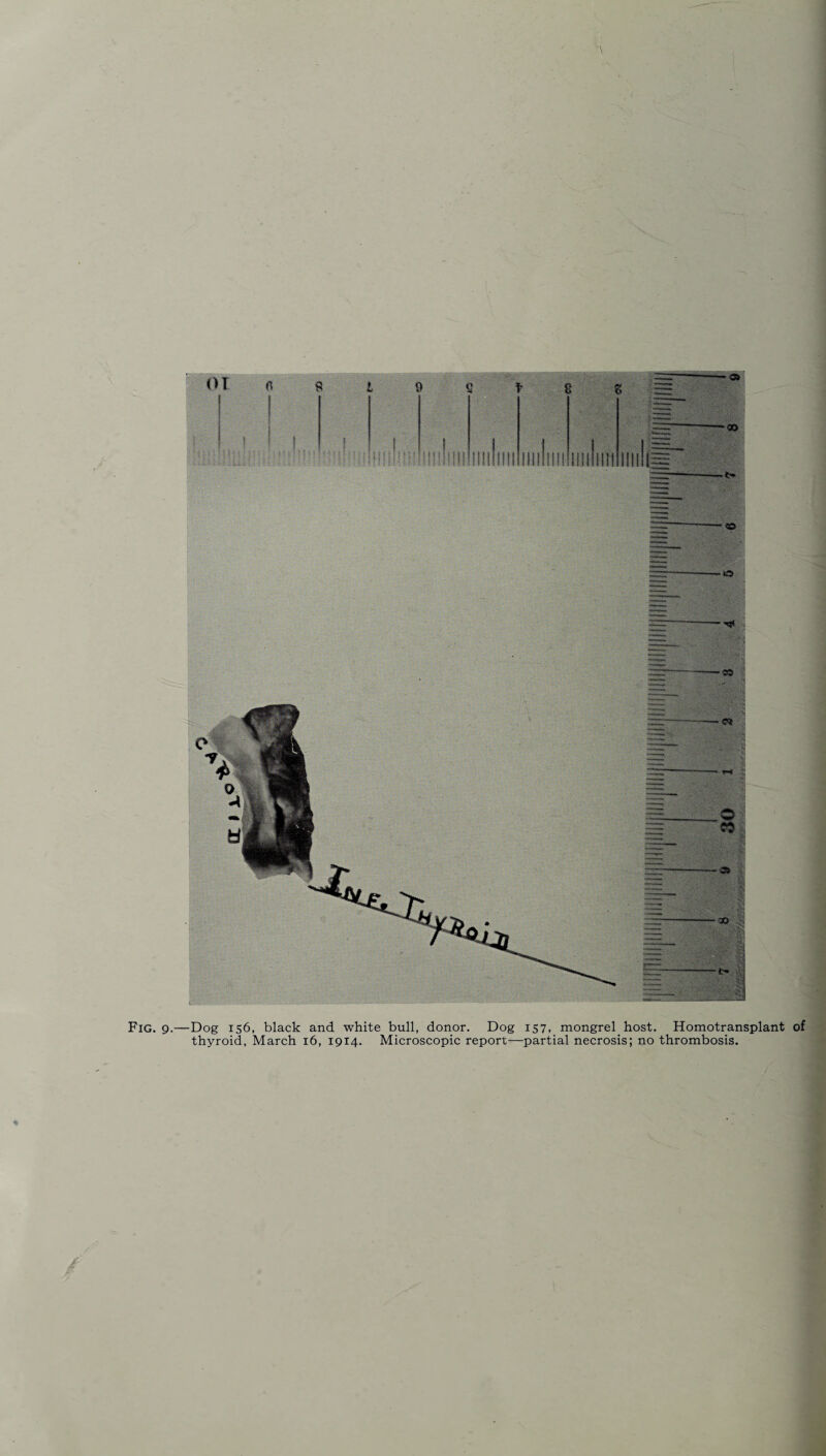 thyroid, March 16, 1914. Microscopic report—partial necrosis; no thrombosis.