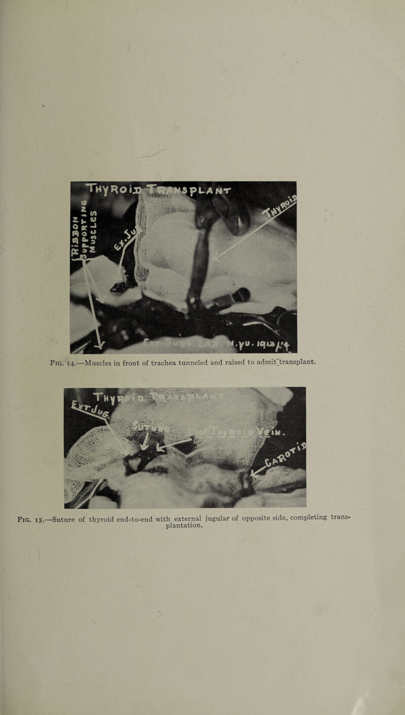 Pig. 15.—Suture of thyroid end-to-end with external jugular of opposite side, plantation. completing trans-