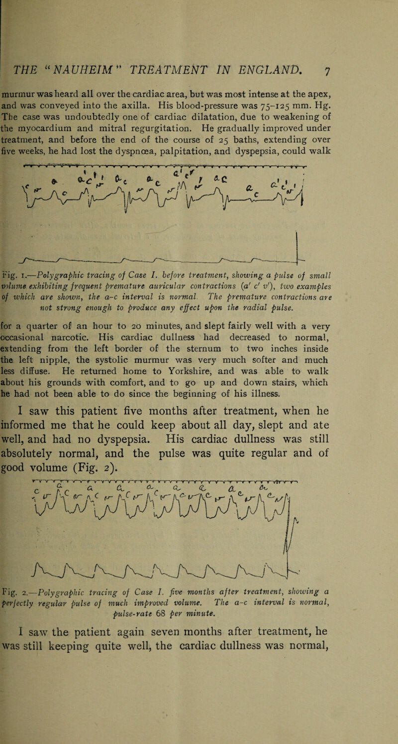 murmur was heard all over the cardiac area, but was most intense at the apex, and was conveyed into the axilla. His blood-pressure was 75-125 mm. Hg. The case was undoubtedly one of cardiac dilatation, due to weakening of the myocardium and mitral regurgitation. He gradually improved under treatment, and before the end of the course of 25 baths, extending over five weeks, he had lost the dyspnoea, palpitation, and dyspepsia, could walk Fig. 1.—Polygraphia tracing of Case I. before treatment, showing a pulse of small volume exhibiting frequent premature auricular contractions (a’ c' v'), two examples of which are shown, the a-c interval is normal. The premature contractions are not strong enough to produce any effect upon the radial pulse. for a quarter of an hour to 20 minutes, and slept fairly well with a very occasional narcotic. His cardiac dullness had decreased to normal, extending from the left border of the sternum to two inches inside the left nipple, the systolic murmur was very much softer and much less difEuse. He returned home to Yorkshire, and was able to walk about his grounds with comfort, and to go up and down stairs, which he had not been able to do since the beginning of his illness. I saw this patient five months after treatment, when he informed me that he could keep about all day, slept and ate well, and had no dyspepsia. His cardiac dullness was still absolutely normal, and the pulse was quite regular and of good volume (Fig. 2). Fig. 2.—Polygraphic tracing of Case I. five months after treatment, showing a perfectly regular pulse of much improved volume. The a-c interval is normal, pulse-rate 68 per minute. I saw the patient again seven months after treatment, he was still keeping quite well, the cardiac dullness was normal,