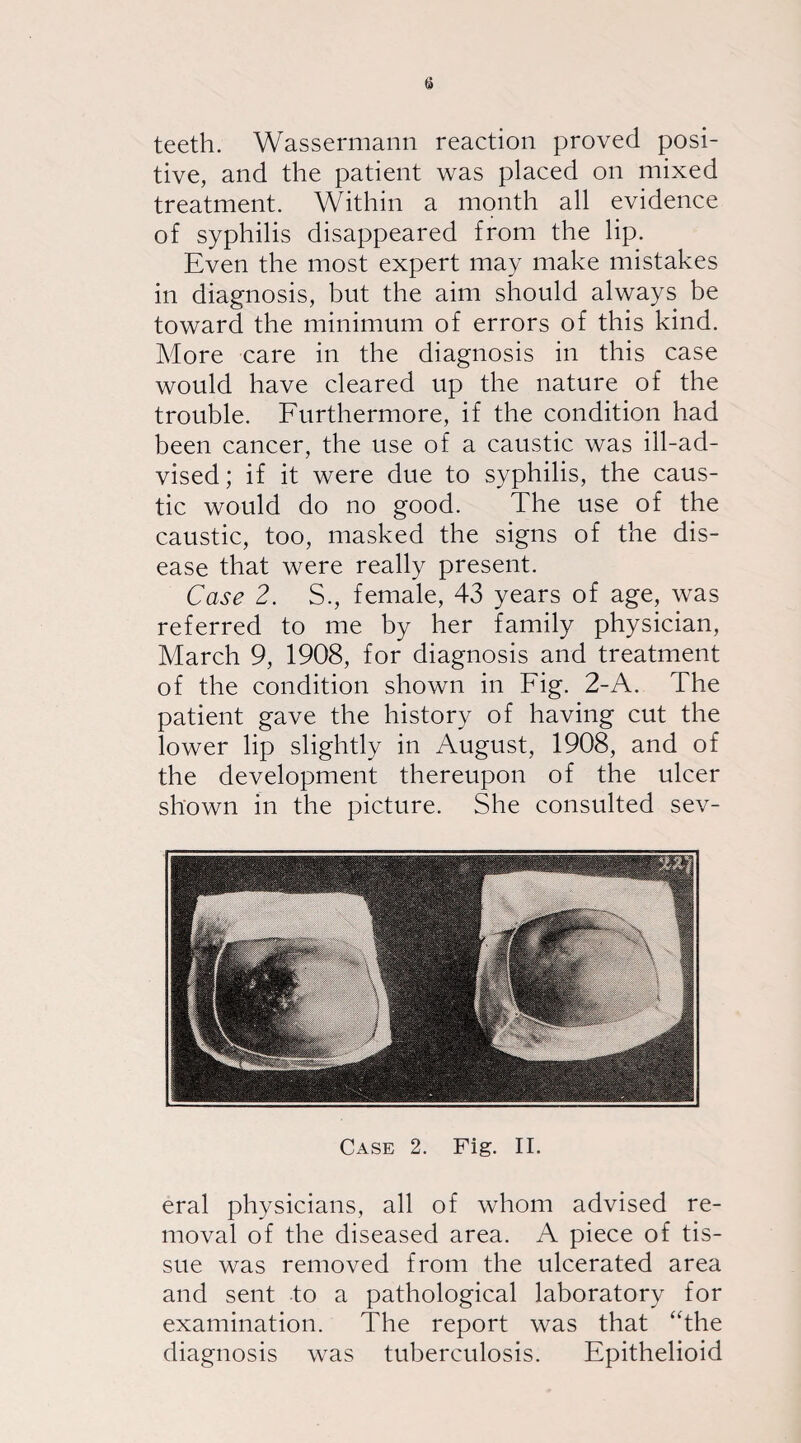 teeth. Wassermann reaction proved posi¬ tive, and the patient was placed on mixed treatment. Within a month all evidence of syphilis disappeared from the lip. Even the most expert may make mistakes in diagnosis, but the aim should always be toward the minimum of errors of this kind. More care in the diagnosis in this case would have cleared up the nature of the trouble. Furthermore, if the condition had been cancer, the use of a caustic was ill-ad¬ vised ; if it were due to syphilis, the caus¬ tic would do no good. The use of the caustic, too, masked the signs of the dis¬ ease that were really present. Case 2. S., female, 43 years of age, was referred to me by her family physician, March 9, 1908, for diagnosis and treatment of the condition shown in Fig. 2-A. The patient gave the history of having cut the lower lip slightly in August, 1908, and of the development thereupon of the ulcer shown in the picture. She consulted sev- Case 2. Fig. II. eral physicians, all of whom advised re¬ moval of the diseased area. A piece of tis¬ sue was removed from the ulcerated area and sent to a pathological laboratory for examination. The report was that “the diagnosis was tuberculosis. Epithelioid