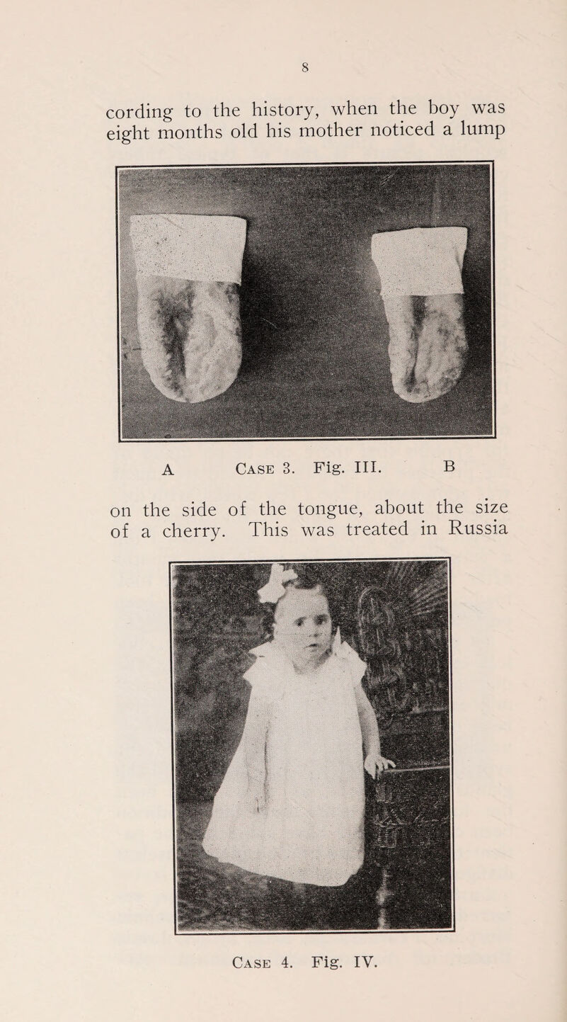 cording to the history, when the boy was eight months old his mother noticed a lump A Case 3. Fig. III. B on the side of the tongue, about the size of a cherry. This was treated in Russia