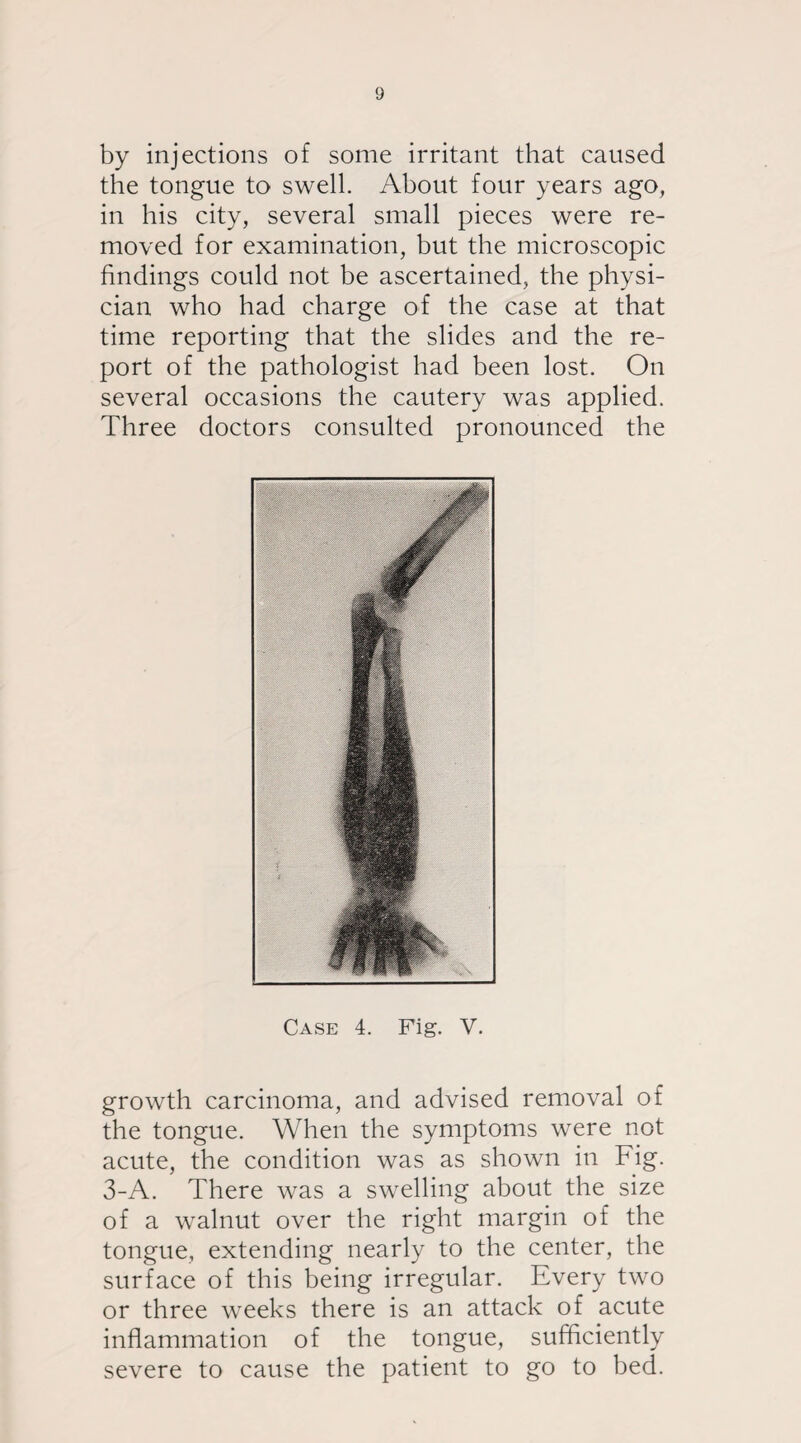 by injections of some irritant that caused the tongue to swell. About four years ago, in his city, several small pieces were re¬ moved for examination, but the microscopic findings could not be ascertained, the physi¬ cian who had charge of the case at that time reporting that the slides and the re¬ port of the pathologist had been lost. On several occasions the cautery was applied. Three doctors consulted pronounced the Case 4. Fig. V. growth carcinoma, and advised removal of the tongue. When the symptoms were not acute, the condition was as shown in Fig. 3-A. There was a swelling about the size of a walnut over the right margin of the tongue, extending nearly to the center, the surface of this being irregular. Every two or three weeks there is an attack of acute inflammation of the tongue, sufficiently severe to cause the patient to go to bed.