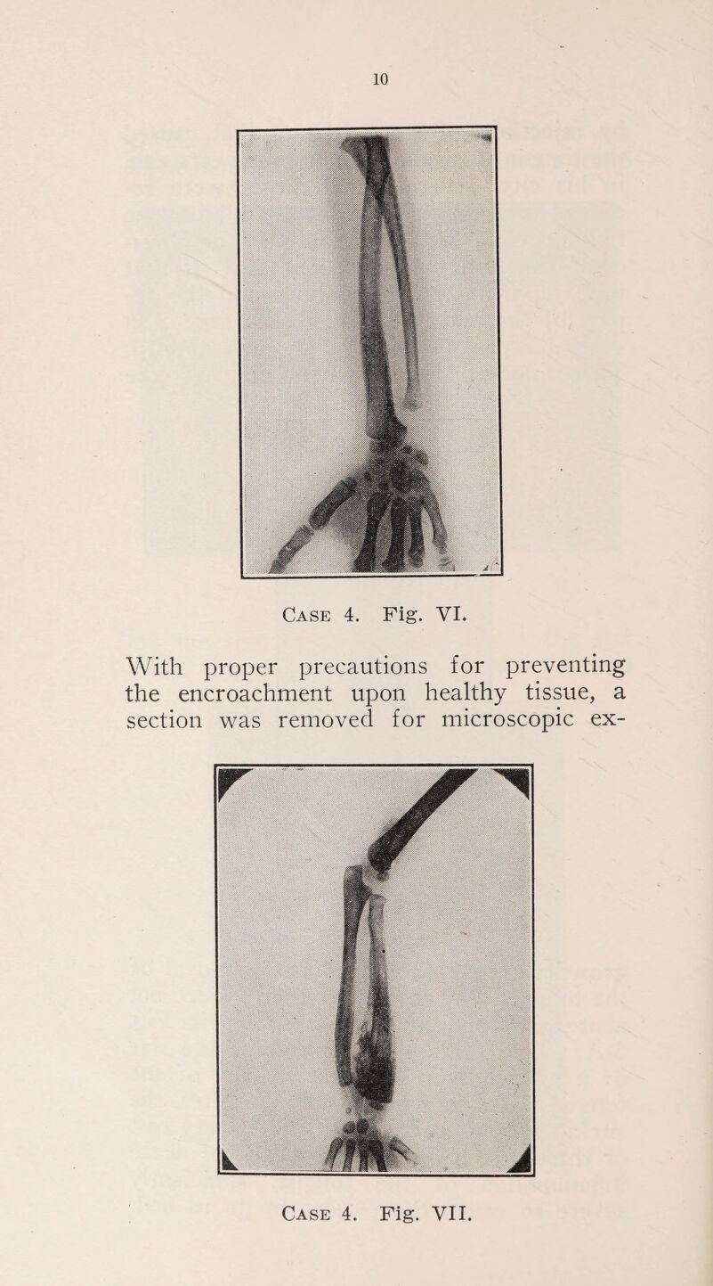 Case 4. Fig. VI. With proper precautions for preventing the encroachment upon healthy tissue, a section was removed for microscopic ex-