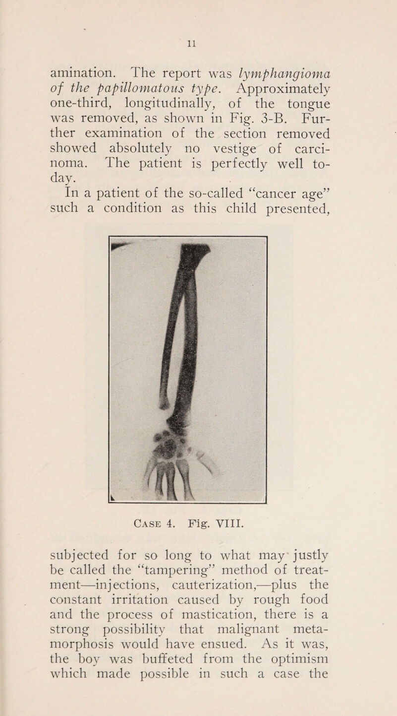 amination. The report was lymphangioma of the papillomatous type. Approximately one-third, longitudinally, of the tongue was removed, as shown in Fig. 3-B. Fur¬ ther examination of the section removed showed absolutely no vestige of carci¬ noma. The patient is perfectly well to¬ day. In a patient of the so-called ‘cancer age” such a condition as this child presented, Case 4. Fig. VIII. subjected for so long to what may justly be called the “tampering” method of treat¬ ment—injections, cauterization,—plus the constant irritation caused by rough food and the process of mastication, there is a strong possibility that malignant meta¬ morphosis would have ensued. As it was, the boy was buffeted from the optimism which made possible in such a case the