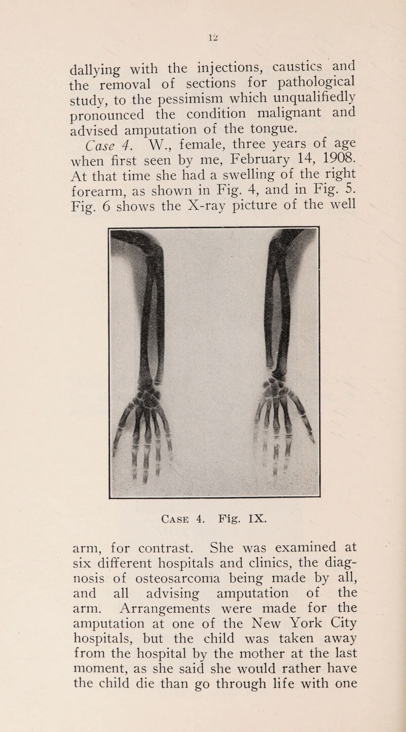 dallying with the injections, caustics and the removal of sections for pathological study, to the pessimism which unqualifiedly pronounced the condition malignant and advised amputation of the tongue. Case 4. W., female, three years of age when first seen by me, February 14, 1908. At that time she had a swelling of the right forearm, as shown in Fig. 4, and in Fig. 5. Fig. 6 shows the X-ray picture of the well Case 4. Fig. IX. arm, for contrast. She was examined at six different hospitals and clinics, the diag¬ nosis of osteosarcoma being made by all, and all advising amputation of the arm. Arrangements were made for the amputation at one of the New York City hospitals, but the child was taken away from the hospital by the mother at the last moment, as she said she would rather have the child die than go through life with one