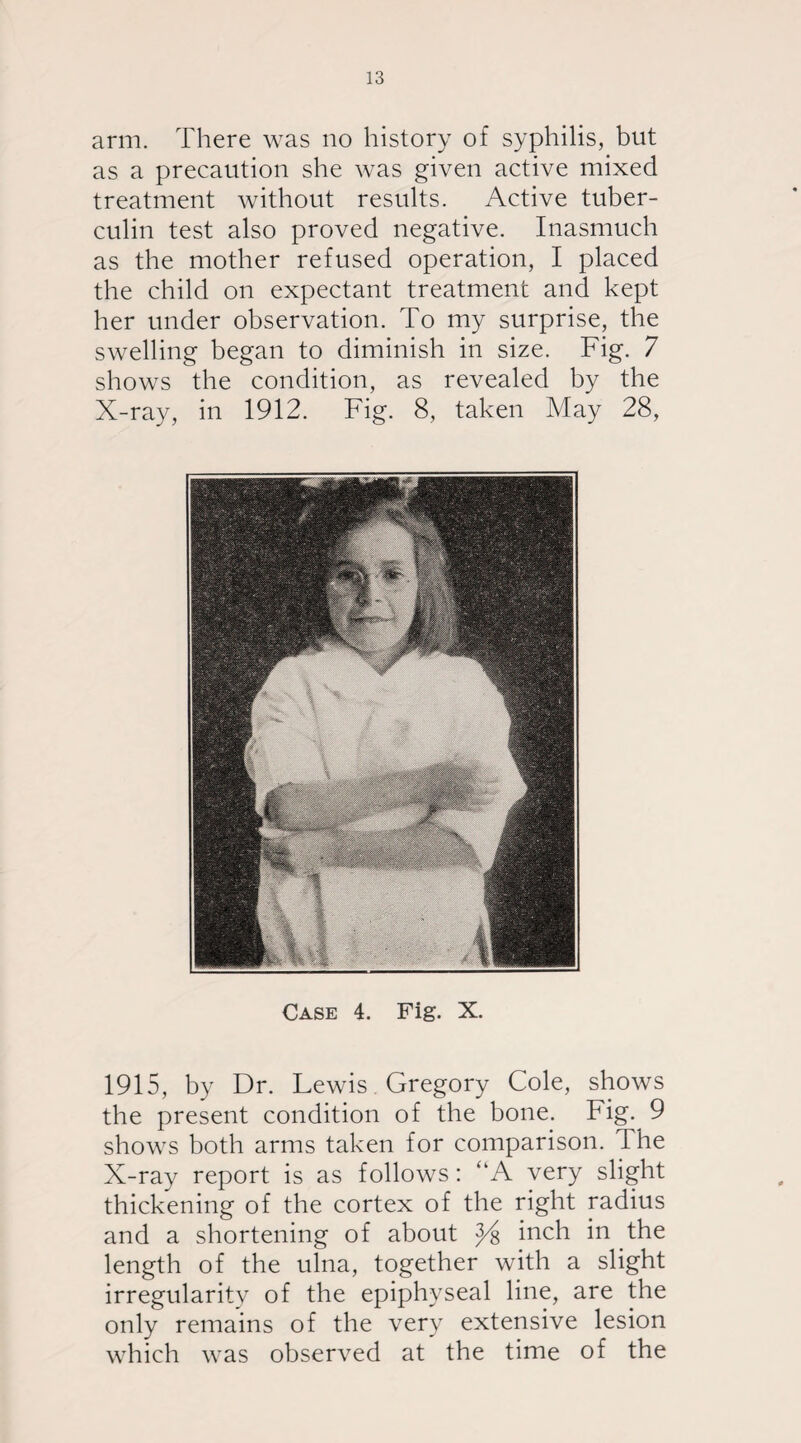 arm. There was no history of syphilis, but as a precaution she was given active mixed treatment without results. Active tuber¬ culin test also proved negative. Inasmuch as the mother refused operation, I placed the child on expectant treatment and kept her under observation. To my surprise, the swelling began to diminish in size. Fig. 7 shows the condition, as revealed by the X-ray, in 1912. Fig. 8, taken May 28, Case 4. Fig. X. 1915, by Dr. Lewis Gregory Cole, shows the present condition of the bone. Fig. 9 shows both arms taken for comparison. The X-ray report is as follows: “A very slight thickening of the cortex of the right radius and a shortening of about inch in the length of the ulna, together with a slight irregularity of the epiphyseal line, are the only remains of the very extensive lesion which was observed at the time of the