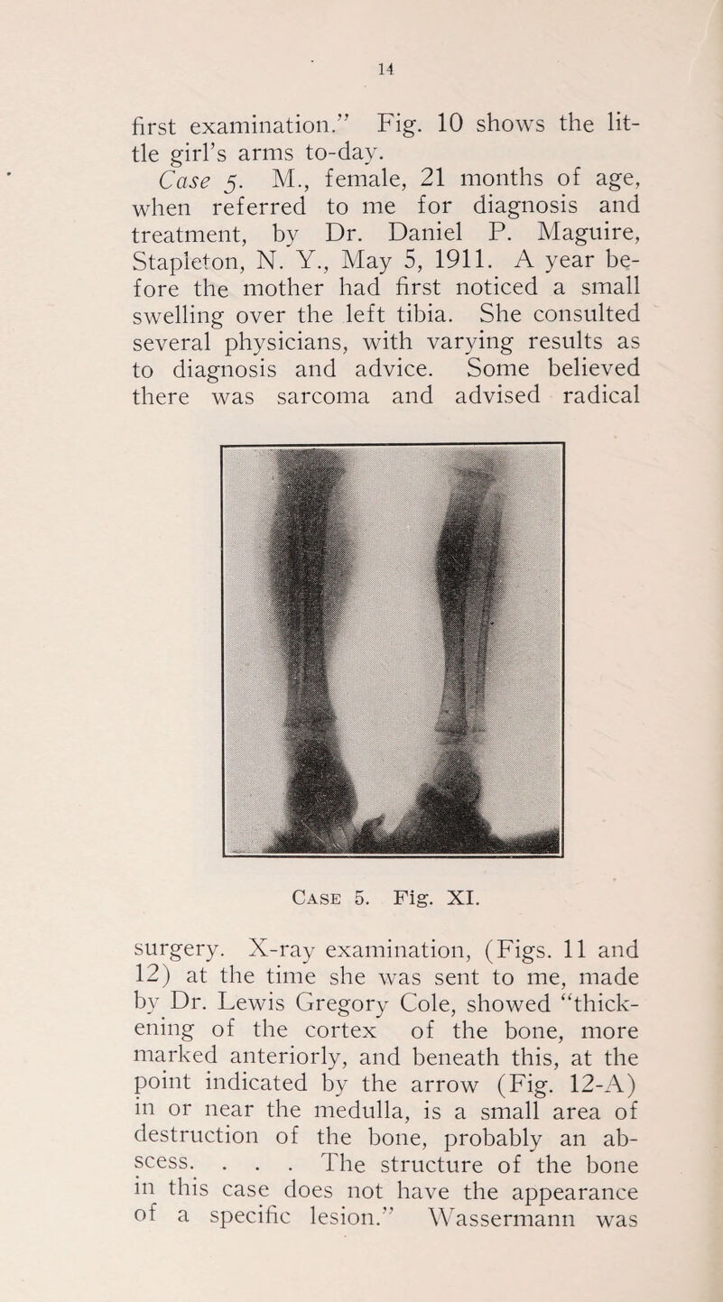 first examination.” Fig. 10 shows the lit¬ tle girl’s arms to-day. Case 5. M., female, 21 months of age, when referred to me for diagnosis and treatment, by Dr. Daniel P. Maguire, Stapleton, N. Y., May 5, 1911. A year be¬ fore the mother had first noticed a small swelling over the left tibia. She consulted several physicians, with varying results as to diagnosis and advice. Some believed there was sarcoma and advised radical Case 5. Fig. XI. surgery. X-ray examination, (Figs. 11 and 12) at the time she was sent to me, made by Dr. Lewis Gregory Cole, showed ‘'thick¬ ening of the cortex of the bone, more marked anteriorly, and beneath this, at the point indicated by the arrow (Fig. 12-A) in or near the medulla, is a small area of destruction of the bone, probably an ab¬ scess. . . . The structure of the bone in this case does not have the appearance of a specific lesion. Wassermann was