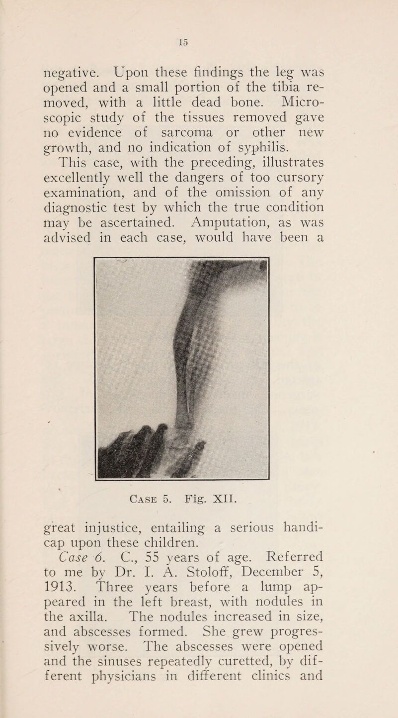 negative. Upon these findings the leg was opened and a small portion of the tibia re¬ moved, with a little dead bone. Micro¬ scopic study of the tissues removed gave no evidence of sarcoma or other new growth, and no indication of syphilis. This case, with the preceding, illustrates excellently well the dangers of too cursory examination, and of the omission of any diagnostic test by which the true condition may be ascertained. Amputation, as was advised in each case, would have been a Case 5. Fig. XII. great injustice, entailing a serious handi¬ cap upon these children. Case 6. C., 55 years of age. Referred to me by Dr. I. A. Stoloff, December 5, 1913. Three years before a lump ap¬ peared in the left breast, with nodules in the axilla. The nodules increased in size, and abscesses formed. She grew progres¬ sively worse. The abscesses were opened and the sinuses repeatedly curetted, by dif¬ ferent physicians in different clinics and