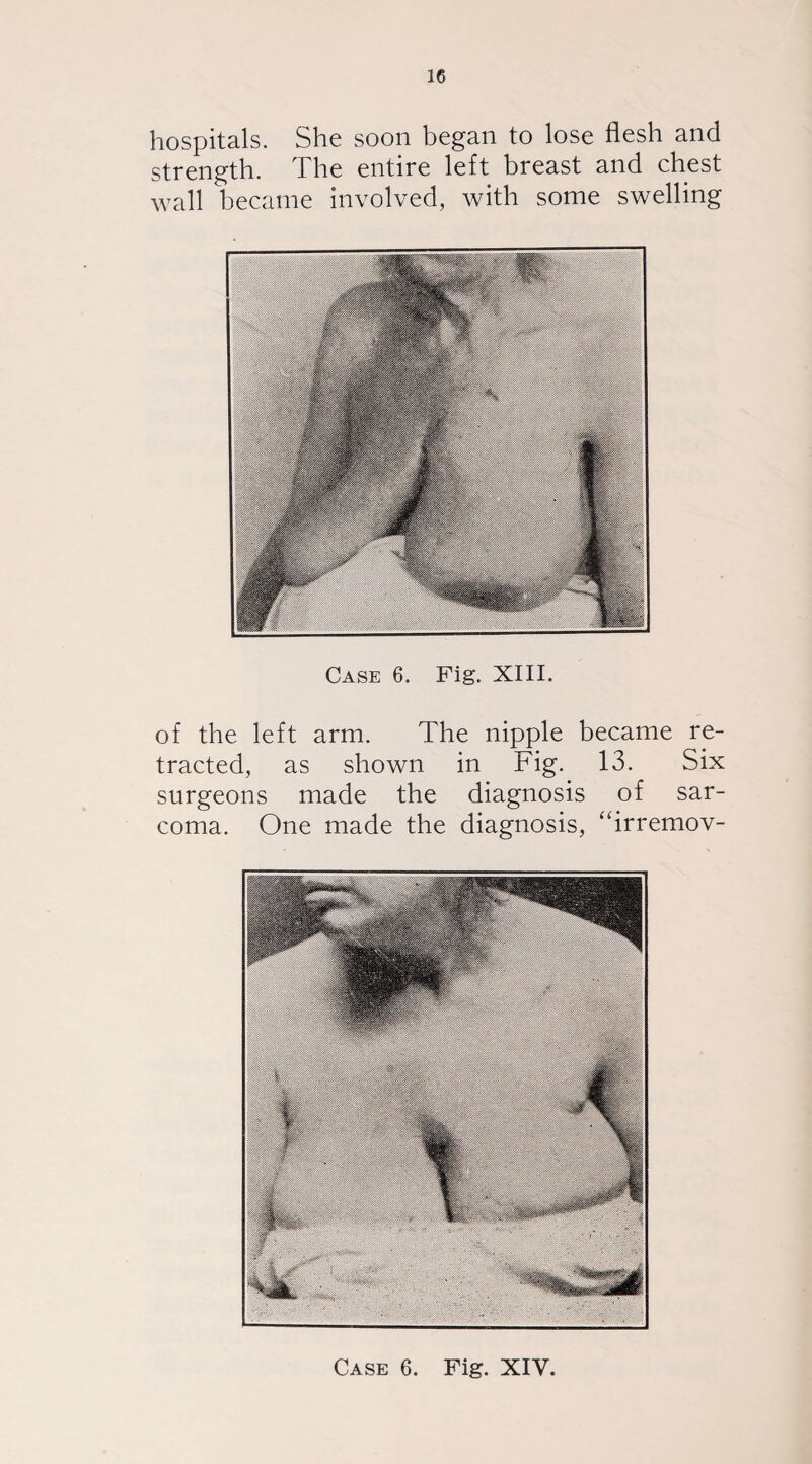 hospitals. She soon began to lose flesh and strength. The entire left breast and chest wall became involved, with some swelling Case 6. Fig. XIII. of the left arm. The nipple became re¬ tracted, as shown in Fig. 13. Six surgeons made the diagnosis of sar¬ coma. One made the diagnosis, “irremov-