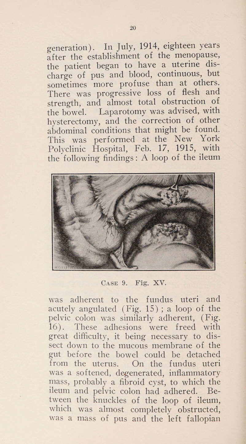 generation). In July, 1914, eighteen years after the establishment of the menopause, the patient began to have a uterine dis¬ charge of pus and blood, continuous, but sometimes more profuse than at others. There was progressive loss of flesh and strength, and almost total obstruction of the bowel. Laparotomy was advised, with hysterectomy, and the correction of other abdominal conditions that might be found. This was performed at the New York Polyclinic Hospital, Feb. 17, 1915, with the following findings: A loop of the ileum Case 9. Fig. XV. was adherent to the fundus uteri and acutely angulated (Fig. 15) ; a loop of the pelvic colon was similarly adherent, (Fig. 16). These adhesions were freed with great difficulty, it being necessary to dis¬ sect down to the mucous membrane of the gut before the bowel could be detached from the uterus. On the fundus uteri was a softened, degenerated, inflammatory mass, probably a fibroid, cyst, to which the ileum and pelvic colon had adhered. Be¬ tween the knuckles of the loop of ileum, which was almost completely obstructed, was a mass of pus and the left fallopian