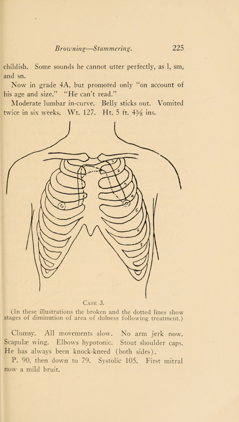 childish. Some sounds he cannot utter perfectly, as 1, sm, and sn. Now in grade 4A, but promoted only “on account of his age and size.” “Hie can't read.” Moderate lumbar in-curve. Belly sticks out. Vomited twice in six weeks. Wt. 127. Ht. 5 ft. 4^ ins. (In these illustrations the broken and the dotted lines show stages of diminution of area of dulness following treatment.) Clumsy. All movements slow. No arm jerk now. Scapulae wing. Elbows hypotonic. Stout shoulder caps. He has always been knock-kneed (both sides). P. 90, then down to 79. Systolic 105. First mitral now a mild bruit.