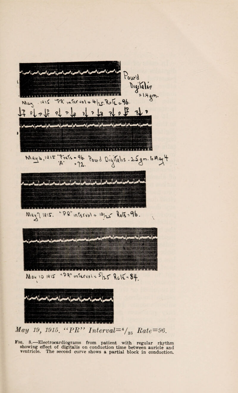 Nu^\ \q\s\  ^ u\TiWo\ 'Q]njT' \<i(i - . Mum \o i<uy %r ^aC'-Sif. -Z9-Z5. “PR” Interval—4/25 Rate—96. Fig. 8.—Electrocardiograms from patient with regular rhythm showing effect of digitalis on conduction time between auricle and ventricle. The second curve shows a partial block in conduction.
