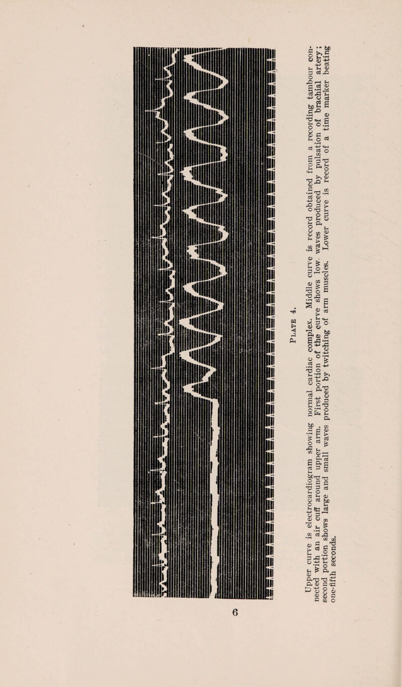 Upper curve is electrocardiogram showing normal cardiac complex. Middle curve is record obtained from a recording tambour con¬ nected with an air cuff around upper arm. First portion of the curve shows low waves produced by pulsation of brachial artery; second portion shows large and small waves produced by twitching of arm muscles. Lower curve is record of a time marker beating one-fifth seconds.