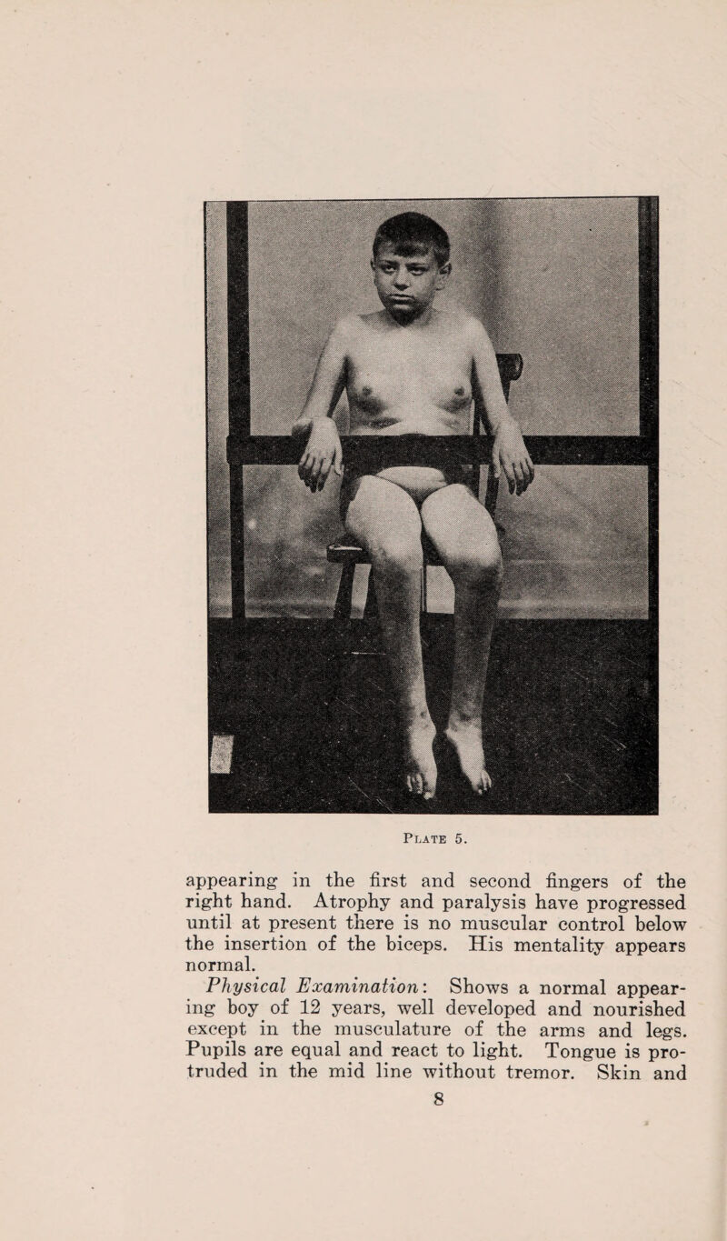 appearing in the first and second fingers of the right hand. Atrophy and paralysis have progressed until at present there is no muscular control below the insertion of the biceps. His mentality appears normal. Physical Examination: Shows a normal appear¬ ing boy of 12 years, well developed and nourished except in the musculature of the arms and legs. Pupils are equal and react to light. Tongue is pro¬ truded in the mid line without tremor. Skin and