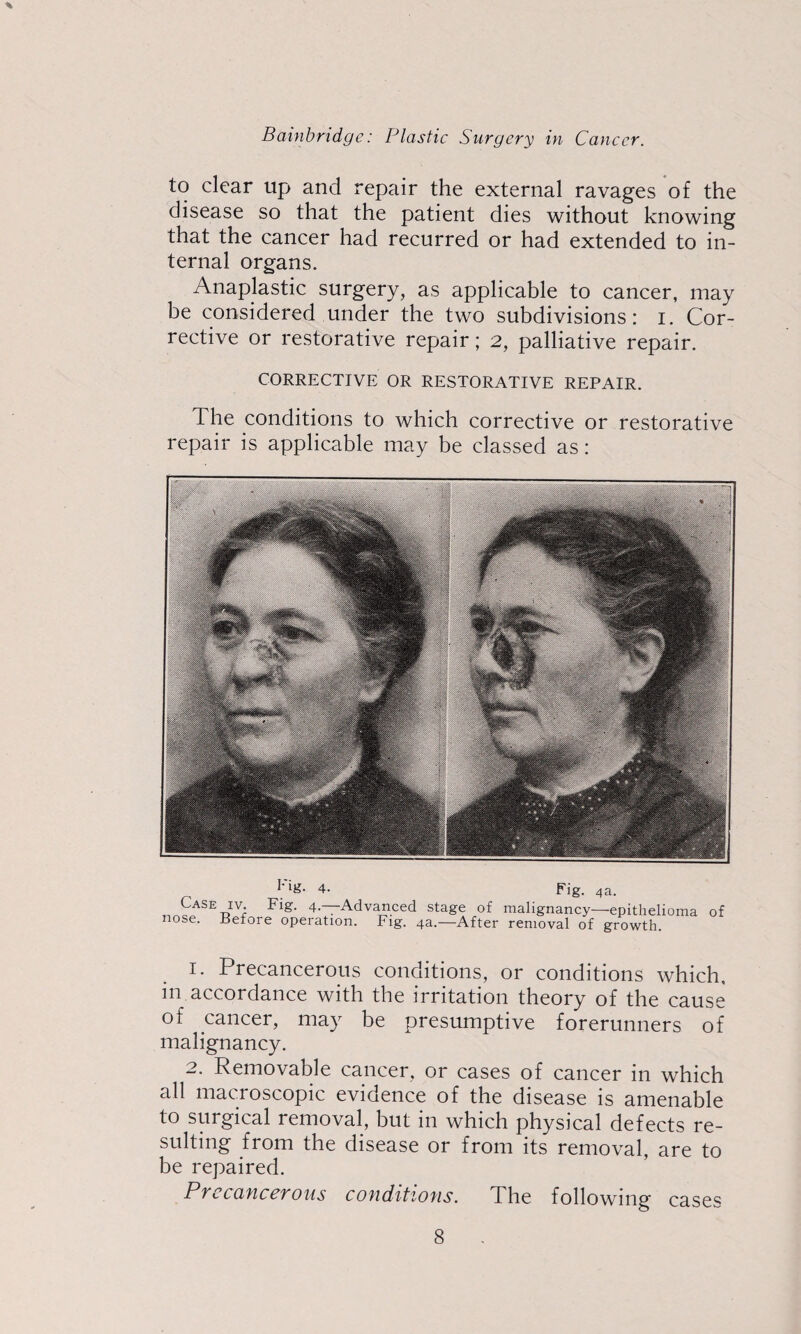 to clear up and repair the external ravages of the disease so that the patient dies without knowing that the cancer had recurred or had extended to in¬ ternal organs. Anaplastic surgery, as applicable to cancer, may be considered under the two subdivisions: i. Cor¬ rective or restorative repair; 2, palliative repair. CORRECTIVE OR RESTORATIVE REPAIR. The conditions to which corrective or restorative repair is applicable may be classed as: Case nose. 4. Fig. 4a. IV. Fig. 4.—Advanced stage of malignancy—epithelioma of Retore operation. Fig. 4a.—After removal of growth. 1. Precancerous conditions, or conditions which, in accordance with the irritation theory of the cause of cancer, may be presumptive forerunners of malignancy. 2. Removable cancer, or cases of cancer in which all macroscopic evidence of the disease is amenable to surgical removal, but in which physical defects re¬ sulting from the disease or from its removal, are to be repaired. Precancerous conditions. The following cases