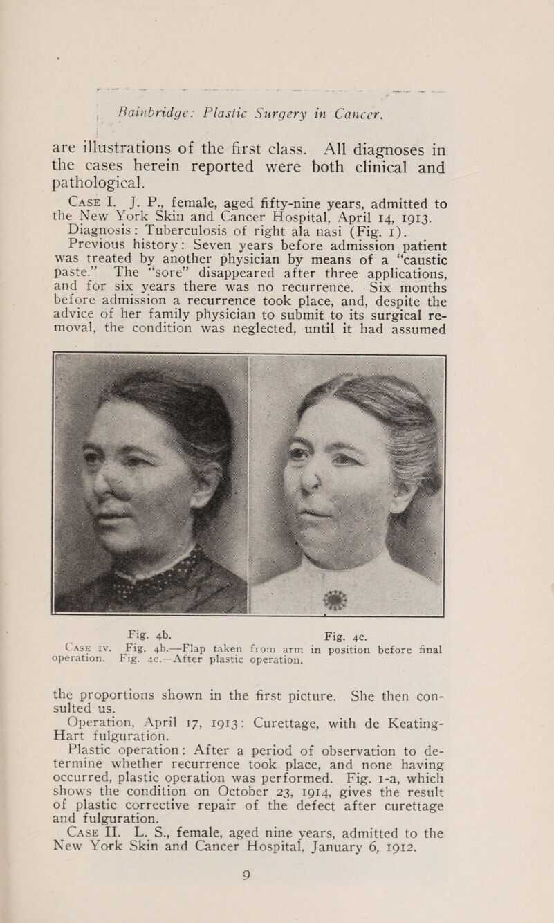 are illustrations of the first class. All diagnoses in the cases herein reported were both clinical and pathological. Case I. J. P., female, aged fifty-nine years, admitted to the New York Skin and Cancer Hospital, April 14, 1913. Diagnosis: Tuberculosis of right ala nasi (Fig. i). Previous history: Seven years before admission patient was treated by another physician by means of a “caustic paste.” The “sore” disappeared after three applications, and for six years there was no recurrence. Six months before admission a recurrence took place, and, despite the advice of her family physician to submit to its surgical re¬ moval, the condition was neglected, until it had assumed Fig. 4b. Fig. 4C. Case iv. Fig, 4b.—Flap taken from arm in position before final operation. Fig. 4c.—After plastic operation. the proportions shown in the first picture. She then con¬ sulted us. Operation, April 17, 1913: Curettage, with de Keating- Hart fulguration. Plastic operation: After a period of observation to de¬ termine whether recurrence took place, and none having occurred, plastic operation was performed. Fig. i-a, which shows the condition on October 23, 1914, gives the result of plastic corrective repair of the defect after curettage and fulguration. Case II. L._ S., female, aged nine years, admitted to the New York Skin and Cancer Hospital, January 6, 1912.