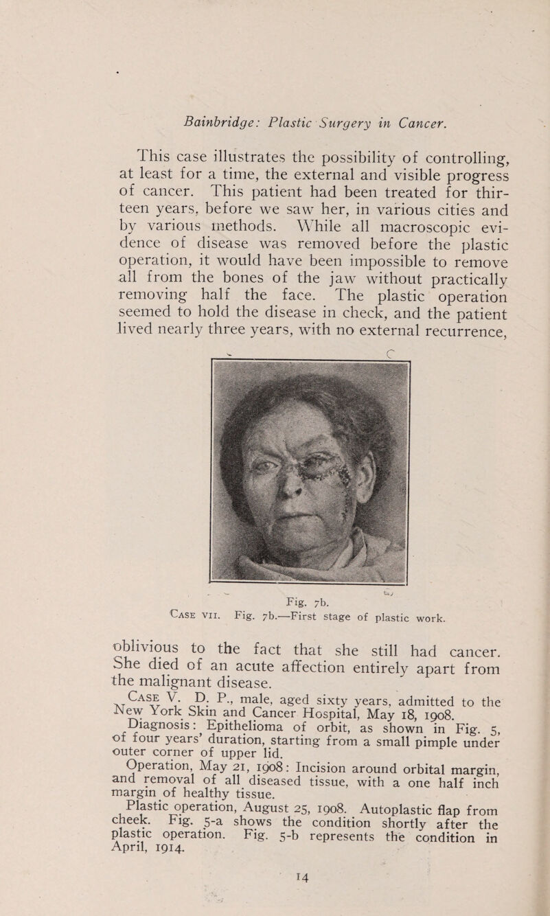 This case illustrates the possibility of controlling, at least for a time, the external and visible progress of cancer. This patient had been treated for thir¬ teen years, before we saw her, in various cities and by various methods. While all macroscopic evi¬ dence of disease was removed before the plastic operation, it would have been impossible to remove all from the bones of the jaw without practically removing half the face. The plastic operation seemed to hold the disease in check, and the patient lived nearly three years, with no external recurrence, ^ r Fig. 7b. Case vii. Fig. 7b.—First stage of plastic work. oblivious to the fact that she still had cancer. She died of an acute affection entirely apart from the malignant disease. Case V. p. P., male, aged sixty years, admitted to the York Skin and Cancer Hospital, May 18, 1908. Diagnosis: Epithelioma of orbit, as shown in Fig. 5, of four years duration, starting from a small pimple under outer corner of upper lid. Operation, May 21, 1908: Incision around orbital margin, and removal of all diseased tissue, with a one half inch margin of healthy tissue. Plastic operation, August 25, 1908. Autoplastic flap from cheek. Fig. 5-a shows the condition shortly after the plaspc operation. Fig. 5-b represents the condition in April, 1914.
