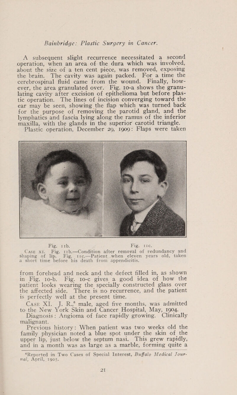 A subsequent slight recurrence necessitated a second operation, when an area of the dura which was involved, about the size of a ten cent piece, was removed, exposing the brain. The cavity was again packed. For a time the cerebrospinal fluid came from the wound. Finally, how¬ ever, the area granulated over. Fig. lo-a shows the granu¬ lating cavity after excision of epithelioma but before plas¬ tic operation. The lines of incision converging toward the ear may be seen, showing the flap which was turned back for the purpose of removing the parotid gland, and the lymphatics and fascia lying along the ramus of the_ inferior maxilla, with the glands in the superior carotid triangle. Plastic operation, December 29, 1909: Flaps were taken Fig. iib. Fig. lie. Case xi. Fig. iib.—Condition after removal of redundancy and shaping of lip. Fig. iic.—Patient when eleven years old, taken a short time before his death from appendicitis. from forehead and neck and the defect filled in, as shown in Fig. lo-b. Fig. lo-c gives a good idea of how the patient looks wearing the specially constructed glass over the affected side. There is no recurrence, and the patient is perfectly well at the present time. Case XI. J. R.,® male, aged five months, was admitted to the New York Skin and Cancer Hospital, May, 1904. Diagnosis : Angioma of face rapidly growing. Clinically malignant. Previous history: When patient was two weeks old the family physician noted a blue spot under the skin of^ the upper lip, just below the septum nasi. This grew rapidly, and in a month was as large as a marble, forming quite a Reported in Two Cases of Special Interest, Buffalo Medical Jour¬ nal, April, 1905.