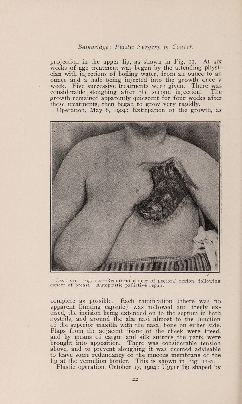 projection in the upper lip, as shown in Fig. ii. At six weeks of age treatment was begun by the attending physi¬ cian with injections of boiling water, from an ounce to an ounce and a half being injected into the growth once a week. Five successive treatments were given. There was considerable sloughing after the second injection. The growth remained apparently quiescent for four weeks after these treatments, then began to grow very rapidly. Operation, May 6, 1904: Extirpation of the growth, as Case xii. Fig. 12.—Recurrent cancer of pectoral region, following cancer of breast. Autoplastic palliative repair. complete as possible. Each ramification (there was no apparent limiting capsule) was followed and freely ex¬ cised,^ the incision being extended on to the septum in both nostrils, and around the alae nasi almost to the junction of the superior maxilla with the nasal bone on either side. Flaps from the adjacent tissue of the cheek were freed, and by means of catgut and silk sutures the parts were brought into apposition. There was considerable tension above, and to prevent sloughing it was deemed advisable to leave some redundancy of the mucous membrane of the lip at the vermilion border. This is shown in Fig. ii-a. Plastic operation, October 17, 1904: Upper lip shaped by