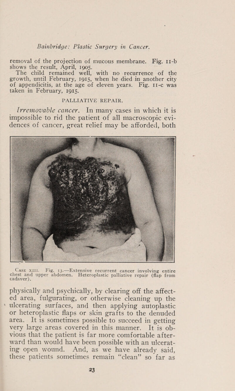 removal of the projection of mucous membrane. Fig. Ii-b shows the result, April, 1905. The child remained well, with no recurrence of the growth, until February, 1915, when he died in another city of appendicitis, at the age of eleven years. Fig. ii-c was taken in February, 1915. PALLIATIVE REPAIR. Irremovable cancer. In many cases in which it is impossible to rid the patient of all macroscopic evi¬ dences of cancer, great relief may be afforded, both Case xiii. Fig. 13.—Extensive recurrent cancer involving entire chest and upper abdomen. Heteroplastic palliative repair (flap from cadaver). physically and psychically, by clearing off the affect¬ ed area, fulgurating, or otherwise cleaning up the ' ulcerating surfaces, and then applying autoplastic or heteroplastic flaps or skin grafts to the denuded area. It is sometimes possible to succeed in getting very large areas covered in this manner. It is ob¬ vious that the patient is far more comfortable after¬ ward than would have been possible with an ulcerat¬ ing open wound. And, as we have already said, these patients sometimes remain “clean” so far as