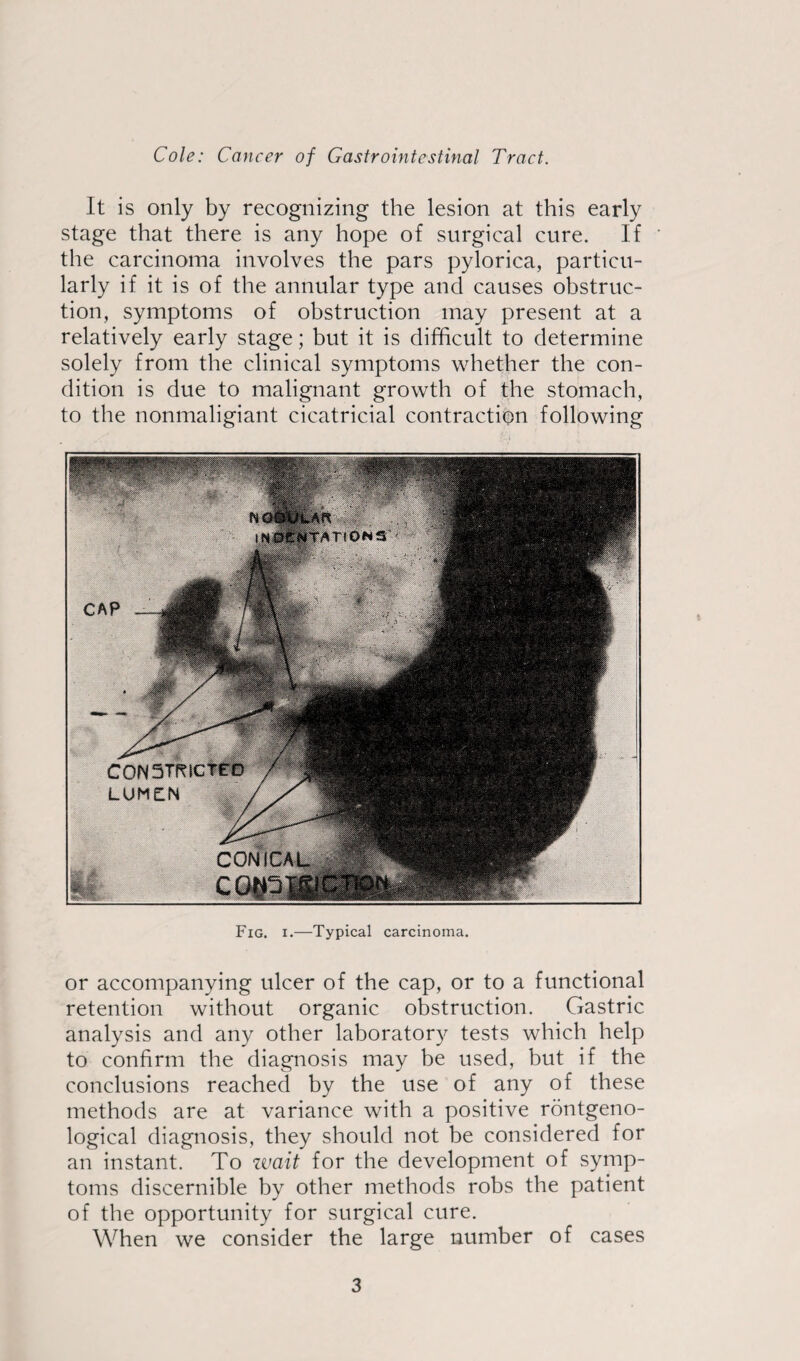 It is only by recognizing the lesion at this early stage that there is any hope of surgical cure. If the carcinoma involves the pars pylorica, particu¬ larly if it is of the annular type and causes obstruc¬ tion, symptoms of obstruction may present at a relatively early stage; but it is difficult to determine solely from the clinical symptoms whether the con¬ dition is due to malignant growth of the stomach, to the nonmaligiant cicatricial contraction following Fig. i.—Typical carcinoma. or accompanying ulcer of the cap, or to a functional retention without organic obstruction. Gastric analysis and any other laboratory tests which help to confirm the diagnosis may be used, but if the conclusions reached by the use of any of these methods are at variance with a positive rontgeno- logical diagnosis, they should not be considered for an instant. To wait for the development of symp¬ toms discernible by other methods robs the patient of the opportunity for surgical cure. When we consider the large number of cases