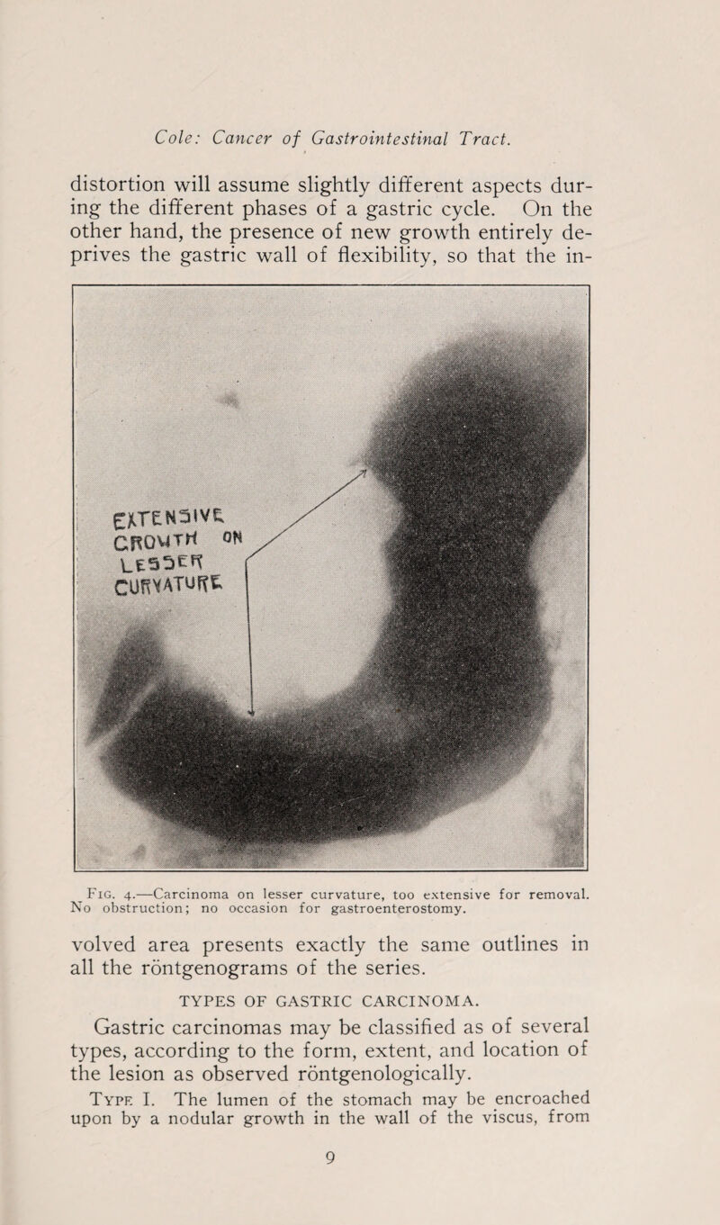 distortion will assume slightly different aspects dur¬ ing the different phases of a gastric cycle. On the other hand, the presence of new growth entirely de¬ prives the gastric wall of flexibility, so that the in- Fig. 4.—Carcinoma on lesser curvature, too extensive for removal. No obstruction; no occasion for gastroenterostomy. volved area presents exactly the same outlines in all the rontgenograms of the series. TYPES OF GASTRIC CARCINOMA. Gastric carcinomas may be classified as of several types, according to the form, extent, and location of the lesion as observed rontgenologically. Type I. The lumen of the stomach may be encroached upon by a nodular growth in the wall of the viscus, from