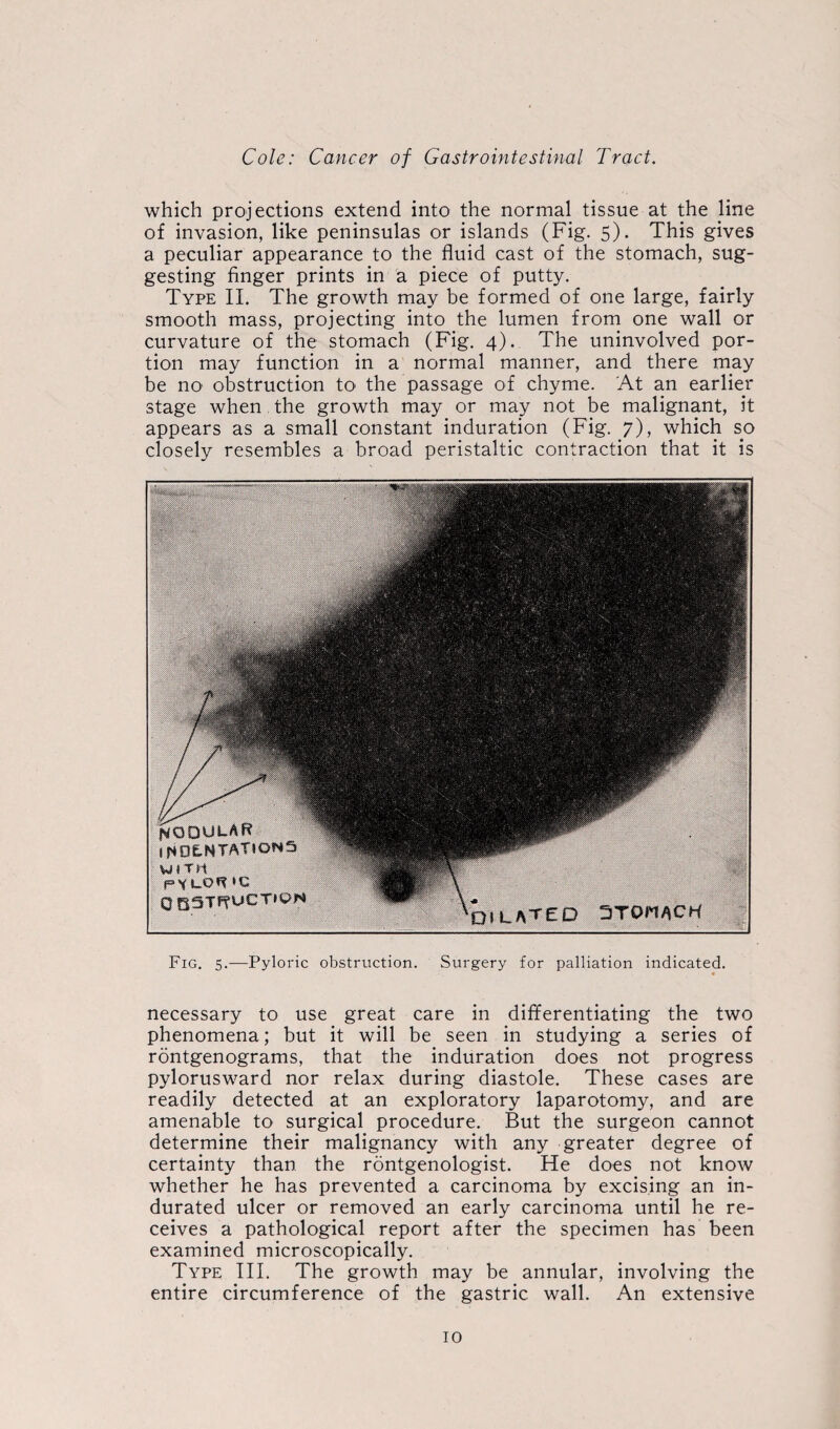 which projections extend into the normal tissue at the line of invasion, like peninsulas or islands (Fig. 5). This gives a peculiar appearance to the fluid cast of the stomach, sug¬ gesting finger prints in a piece of putty. Type II. The growth may be formed of one large, fairly smooth mass, projecting into the lumen from one wall or curvature of the stomach (Fig. 4). The uninvolved por¬ tion may function in a normal manner, and there may be no obstruction to the passage of chyme. At an earlier stage when the growth may or may not be malignant, it appears as a small constant induration (Fig. 7), which so closely resembles a broad peristaltic contraction that it is Fig. 5.—Pyloric obstruction. Surgery for palliation indicated. necessary to use great care in differentiating the two phenomena; but it will be seen in studying a series of rontgenograms, that the induration does not progress pylorusward nor relax during diastole. These cases are readily detected at an exploratory laparotomy, and are amenable to surgical procedure. But the surgeon cannot determine their malignancy with any greater degree of certainty than the rontgenologist. He does not know whether he has prevented a carcinoma by excising an in¬ durated ulcer or removed an early carcinoma until he re¬ ceives a pathological report after the specimen has been examined microscopically. Type III. The growth may be annular, involving the entire circumference of the gastric wall. An extensive