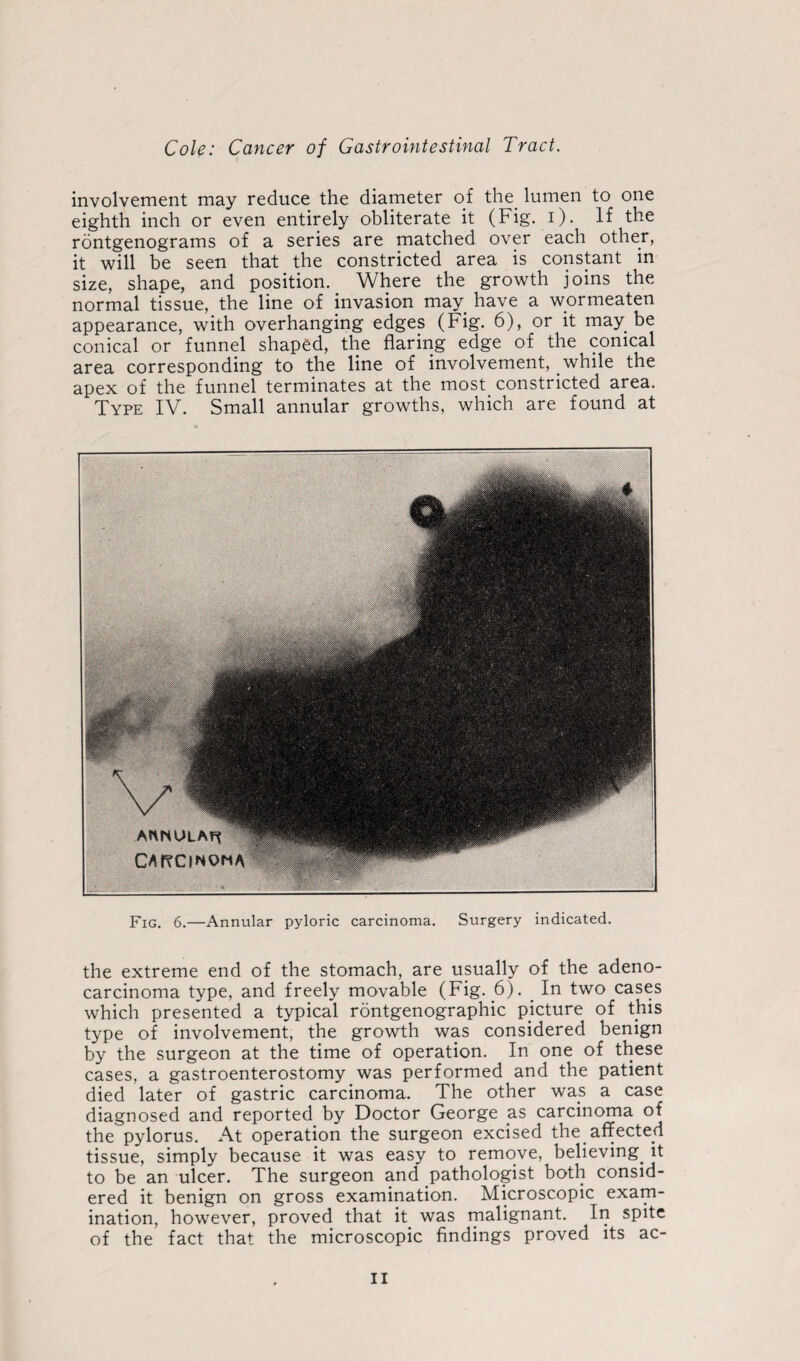 involvement may reduce the diameter of the lumen to one eighth inch or even entirely obliterate it (Fig. i). If the rontgenograms of a series are matched over each other, it will be seen that the constricted area is constant in size, shape, and position. Where the growth joins the normal tissue, the line of invasion may have a wormeaten appearance, with overhanging edges (Fig. 6), or it may be conical or funnel shaped, the flaring edge of the conical area corresponding to the line of involvement, while the apex of the funnel terminates at the most constricted area. Type IV. Small annular growths, which are found at Fig. 6.—Annular pyloric carcinoma. Surgery indicated. the extreme end of the stomach, are usually of the adeno¬ carcinoma type, and freely movable (Fig. 6). In two cases which presented a typical rontgenographic picture of this type of involvement, the growth was considered benign by the surgeon at the time of operation. In one of these cases, a gastroenterostomy was performed and the patient died later of gastric carcinoma. The other was a case diagnosed and reported by Doctor George a.s carcinoma of the pylorus. At operation the surgeon excised the affected tissue, simply because it was easy to remove, believing it to be an ulcer. The surgeon and pathologist both consid¬ ered it benign on gross examination. Microscopic exam¬ ination, however, proved that it was malignant. In spite of the fact that the microscopic findings proved its ac-