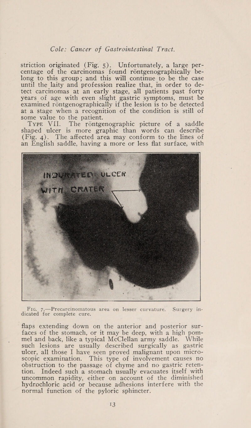 striction originated (Fig. 5). Unfortunately, a large per¬ centage of the carcinomas found rontgenographically be¬ long to this group; and this will continue to be the case until the laity and profession realize that, in order to de¬ tect carcinomas at an early stage, all patients past forty years of age with even slight gastric symptoms, must be examined rontgenographically if the lesion is to be detected at a stage when a recognition of the condition is still of some value to the patient. Type VII. The rontgenographic picture of a saddle shaped ulcer is more graphic than words can describe (Fig. 4). The affected area may conform to the lines of an English saddle, having a more or less flat surface, with Fig. 7.—-Precarcinomatous area on lesser curvature. Surgery in¬ dicated for complete cure. flaps extending down on the anterior and posterior sur¬ faces of the stomach, or it may be deep, with a high pom¬ mel and back, like a typical McClellan army saddle. While such lesions are usually described surgically as gastric ulcer, all those I have seen proved malignant upon micro¬ scopic examination. This type of involvement causes no obstruction to the passage of chyme and no gastric reten¬ tion. Indeed such a stomach usually evacuates itself with uncommon rapidity, either on account of the diminished hydrochloric acid or because adhesions interfere with the normal function of the pyloric sphincter.