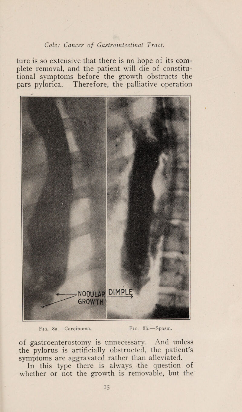 ture is so extensive that there is no hope of its com¬ plete removal, and the patient will die of constitu¬ tional symptoms before the growth obstructs the pars pylorica. Therefore, the palliative operation Fig. 8a.—Carcinoma. Fig. 8b.—Spasm. of gastroenterostomy is unnecessary. And unless the pylorus is artificially obstructed, the patient’s symptoms are aggravated rather than alleviated. In this type there is always the question of whether or not the growth is removable, but the