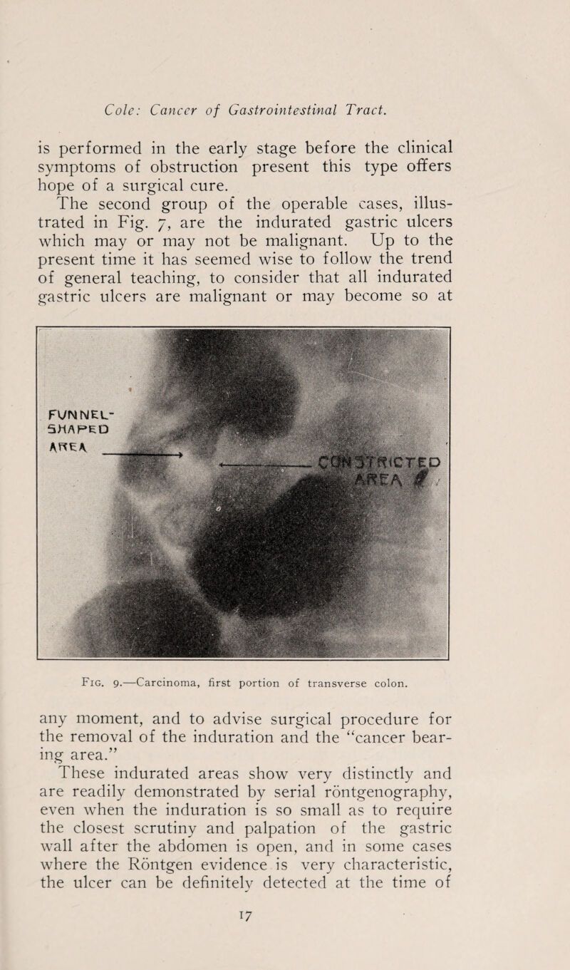 is performed in the early stage before the clinical symptoms of obstruction present this type offers hope of a surgical cure. The second group of the operable cases, illus¬ trated in Fig. 7, are the indurated gastric ulcers which may or may not be malignant. Up to the present time it has seemed wise to follow the trend of general teaching, to consider that all indurated gastric ulcers are malignant or may become so at Fig. 9.—Carcinoma, first portion of transverse colon. any moment, and to advise surgical procedure for the removal of the induration and the “cancer bear¬ ing area.” These indurated areas show very distinctly and are readily demonstrated by serial rontgenography, even when the induration is so small as to require the closest scrutiny and palpation of the gastric wall after the abdomen is open, and in some cases where the Rontgen evidence is very characteristic, the ulcer can be definitely detected at the time of