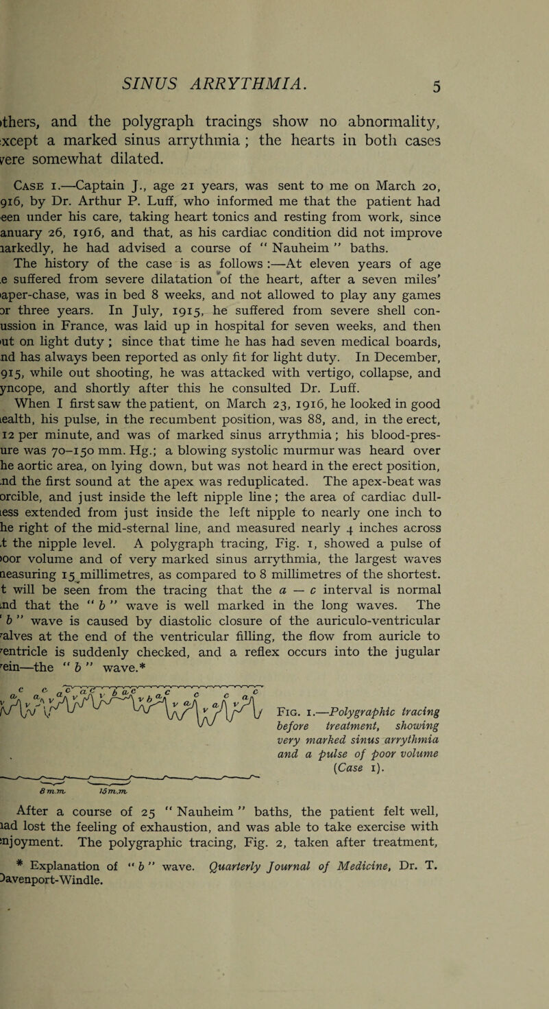 >thers, and the polygraph tracings show no abnormality, xcept a marked sinus arrythmia ; the hearts in both cases yere somewhat dilated. Case i.—Captain J., age 21 years, was sent to me on March 20, 916, by Dr. Arthur P. Luff, who informed me that the patient had een under his care, taking heart tonics and resting from work, since anuary 26, 1916, and that, as his cardiac condition did not improve larkedly, he had advised a course of “ Nauheim ” baths. The history of the case is as follows :—At eleven years of age e suffered from severe dilatation bf the heart, after a seven miles’ >aper-chase, was in bed 8 weeks, and not allowed to play any games Dr three years. In July, 1915, he suffered from severe shell con- ussion in France, was laid up in hospital for seven weeks, and then »ut on light duty ; since that time he has had seven medical boards, nd has always been reported as only fit for light duty. In December, 915, while out shooting, he was attacked with vertigo, collapse, and yncope, and shortly after this he consulted Dr. Luff. When I first saw the patient, on March 23, 1916, he looked in good tealth, his pulse, in the recumbent position, was 88, and, in the erect, 12 per minute, and was of marked sinus arrythmia; his blood-pres- ure was 70-150 mm. Hg.; a blowing systolic murmur was heard over he aortic area, on lying down, but was not heard in the erect position, ,nd the first sound at the apex was reduplicated. The apex-beat was orcible, and just inside the left nipple line; the area of cardiac dull- less extended from just inside the left nipple to nearly one inch to he right of the mid-sternal line, and measured nearly 4 inches across ,t the nipple level. A polygraph tracing, Fig. 1, showed a pulse of >oor volume and of very marked sinus arrythmia, the largest waves neasuring 15 millimetres, as compared to 8 millimetres of the shortest, t will be seen from the tracing that the a — c interval is normal md that the “ b ” wave is well marked in the long waves. The ‘ b ” wave is caused by diastolic closure of the auriculo-ventricular calves at the end of the ventricular filling, the flow from auricle to '■entricle is suddenly checked, and a reflex occurs into the jugular rein—the “ b ” wave.* Fig. 1.—Poly graphic tracing before treatment, showing very marked sinus arrythmia and a pulse of poor volume (Case 1). G 7TV.7TV 1577V.7TV After a course of 25 “ Nauheim ” baths, the patient felt well, lad lost the feeling of exhaustion, and was able to take exercise with enjoyment. The polygraphic tracing, Fig. 2, taken after treatment, # Explanation of “ b ” wave. Quarterly Journal of Medicine, Dr. T. 3avenport-Windle.