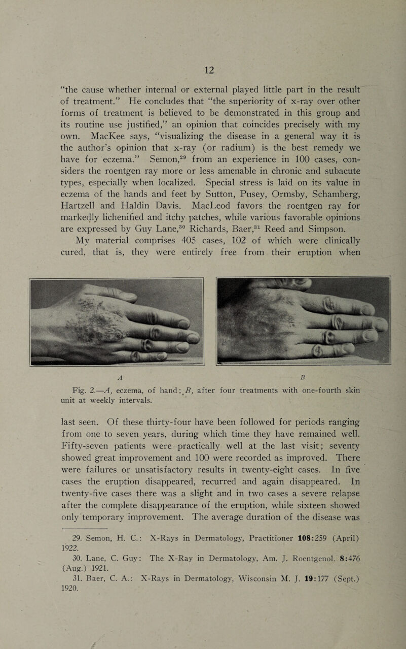 “the cause whether internal or external played little part in the result of treatment.” He concludes that “the superiority of x-ray over other forms of treatment is believed to be demonstrated in this group and its routine use justified,” an opinion that coincides precisely with my own. MacKee says, “visualizing the disease in a general way it is the author’s opinion that x-ray (or radium) is the best remedy we have for eczema.” Semon,29 from an experience in 100 cases, con¬ siders the roentgen ray more or less amenable in chronic and subacute types, especially when localized. Special stress is laid on its value in eczema of the hands and feet by Sutton, Pusey, Ormsby, Schamberg, Hartzell and Haldin Davis. MacLeod favors the roentgen ray for markedly lichenified and itchy patches, while various favorable opinions are expressed by Guy Lane,30 Richards, Baer,31 Reed and Simpson. My material comprises 405 cases, 102 of which were clinically cured, that is, they were entirely free from their eruption when a b Fig. 2.—A, eczema, of handpB, after four treatments with one-fourth skin unit at weekly intervals. last seen. Of these thirty-four have been followed for periods ranging from one to seven years, during which time they have remained well. Fifty-seven patients were practically well at the last visit; seventy showed great improvement and 100 were recorded as improved. There were failures or unsatisfactory results in twenty-eight cases. In five cases the eruption disappeared, recurred and again disappeared. In twenty-five cases there was a slight and in two cases a severe relapse after the complete disappearance of the eruption, while sixteen showed only temporary improvement. The average duration of the disease was 29. Semon, H. C.: X-Rays in Dermatology, Practitioner 108:259 (April) 1922. 30. Lane, C. Guy: The X-Ray in Dermatology, Am. J. Roentgenol. 8:476 (Aug.) 1921. 31. Baer, C. A.: X-Rays in Dermatology, Wisconsin M. J. 19:177 (Sept.) 1920.