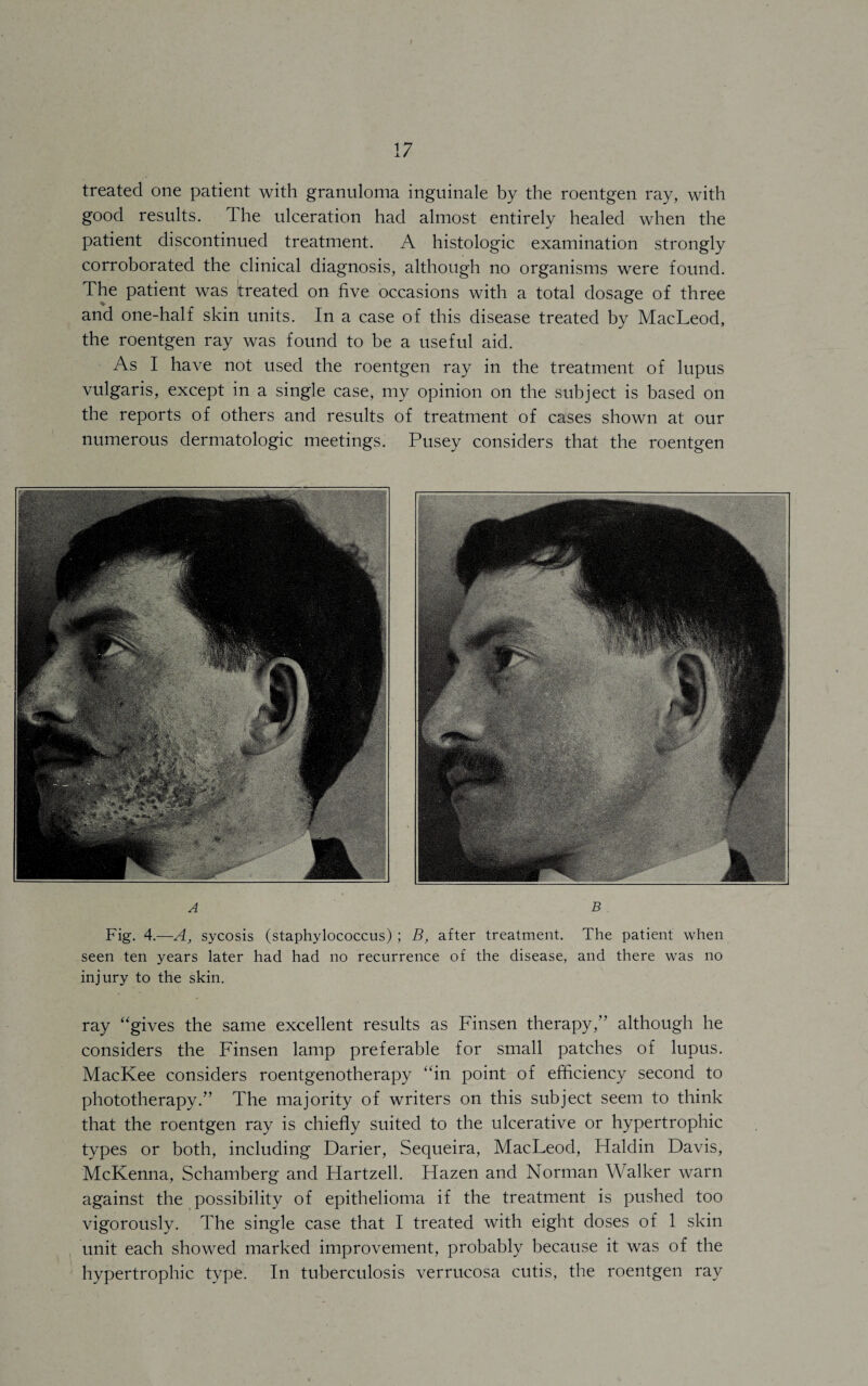 treated one patient with granuloma inguinale by the roentgen ray, with good results. The ulceration had almost entirely healed when the patient discontinued treatment. A histologic examination strongly corroborated the clinical diagnosis, although no organisms were found. The patient was treated on five occasions with a total dosage of three and one-half skin units. In a case of this disease treated by MacLeod, the roentgen ray was found to be a useful aid. As I have not used the roentgen ray in the treatment of lupus vulgaris, except in a single case, my opinion on the subject is based on the reports of others and results of treatment of cases shown at our numerous dermatologic meetings. Pusey considers that the roentgen ray “gives the same excellent results as Finsen therapy,” although he considers the Finsen lamp preferable for small patches of lupus. MacKee considers roentgenotherapy “in point of efficiency second to phototherapy.” The majority of writers on this subject seem to think that the roentgen ray is chiefly suited to the ulcerative or hypertrophic types or both, including Darier, Sequeira, MacLeod, Haldin Davis, McKenna, Schamberg and Hartzell. Hazen and Norman Walker warn against the possibility of epithelioma if the treatment is pushed too vigorously. The single case that I treated with eight doses of 1 skin unit each showed marked improvement, probably because it was of the hypertrophic type. In tuberculosis verrucosa cutis, the roentgen ray Fig. 4.—A, sycosis (staphylococcus) ; B, after treatment. The patient when seen ten years later had had no recurrence of the disease, and there was no injury to the skin.