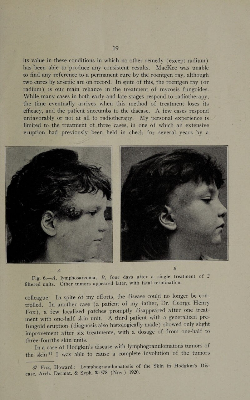 its value in these conditions in which no other remedy (except radium) has been able to produce any consistent results. MacKee was unable to find any reference to a permanent cure by the roentgen ray, although two cures by arsenic are on record. In spite of this, the roentgen ray (or radium) is our main reliance in the treatment of mycosis fungoides. While many cases in both early and late stages respond to radiotherapy, the time eventually arrives when this method of treatment loses its efficacy, and the patient succumbs to the disease. A few cases respond unfavorably or not at all to radiotherapy. My personal experience is limited to the treatment of three cases, in one of which an extensive eruption had previously been held in check for several years by a colleague. In spite of my efforts, the disease could no longer be con¬ trolled. In another case (a patient of my father, Dr. George Henry Fox), a few localized patches promptly disappeared after one treat¬ ment with one-half skin unit. A third patient with a generalized pre- fungoid eruption (diagnosis also histologically made) showed only slight improvement after six treatments, with a dosage of from one-half to three-fourths skin units. In a case of Hodgkin’s disease with lymphogranulomatous tumors of the skin37 I was able to cause a complete involution of the tumors 37. Fox, Howard: Lymphogranulomatosis of the Skin in Hodgkin’s Dis¬ ease, Arch. Dermat. & Syph. 2:578 (Nov.) 1920. Fig. 5.—A, lymphosarcoma; B, four days after a single treatment of 2 filtered units. Other tumors appeared later, with fatal termination.