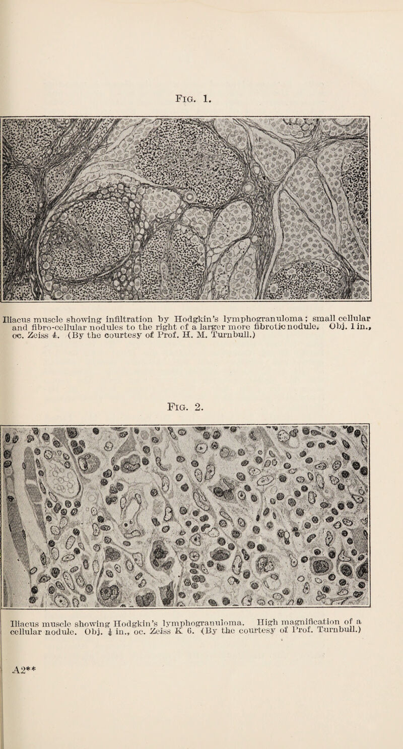 Fig. 1 Iliacns muscle showing infiltration by Hodgkin’s lymphogranuloma; small cellular and fibro-cellular nodules to the right of a larger more fibrotic nodule. Obj. lin., oe. Zeiss 4. (By the courtesy of Prof. H. M. Turnbull.) Fig. 2. Iliacns muscle showing Hodgkin’s lymphogranuloma, cellular nodule. Obj. ^ in., oc. Zeiss K G. {By the c High magnification of a (By the courtesy of Prof. Turnbull.) A2**