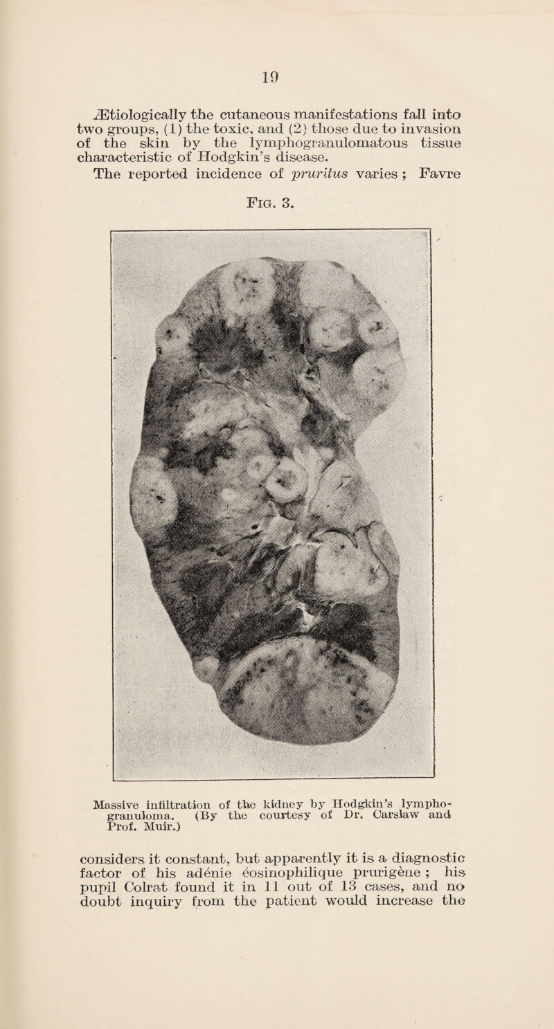 zEtiologically the cutaneous manifestations fall into two groups, (1) the toxic, and (2) those due to invasion of the skin by the lymphogranulomatous tissue characteristic of Hodgkin’s disease. The reported incidence of 'pruritus varies ; Favre Fig. 3. Massive infiltration of the kidney by Hodgkin’s lympho¬ granuloma. (By the courtesy of Dr. Carslaw and Prof. Muir.) considers it constant, but apparently it is a diagnostic factor of his adenie eosinophilique prurigene ; his pupil Colrat found it in 11 out of 13 cases, and no doubt inquiry from the patient would increase the