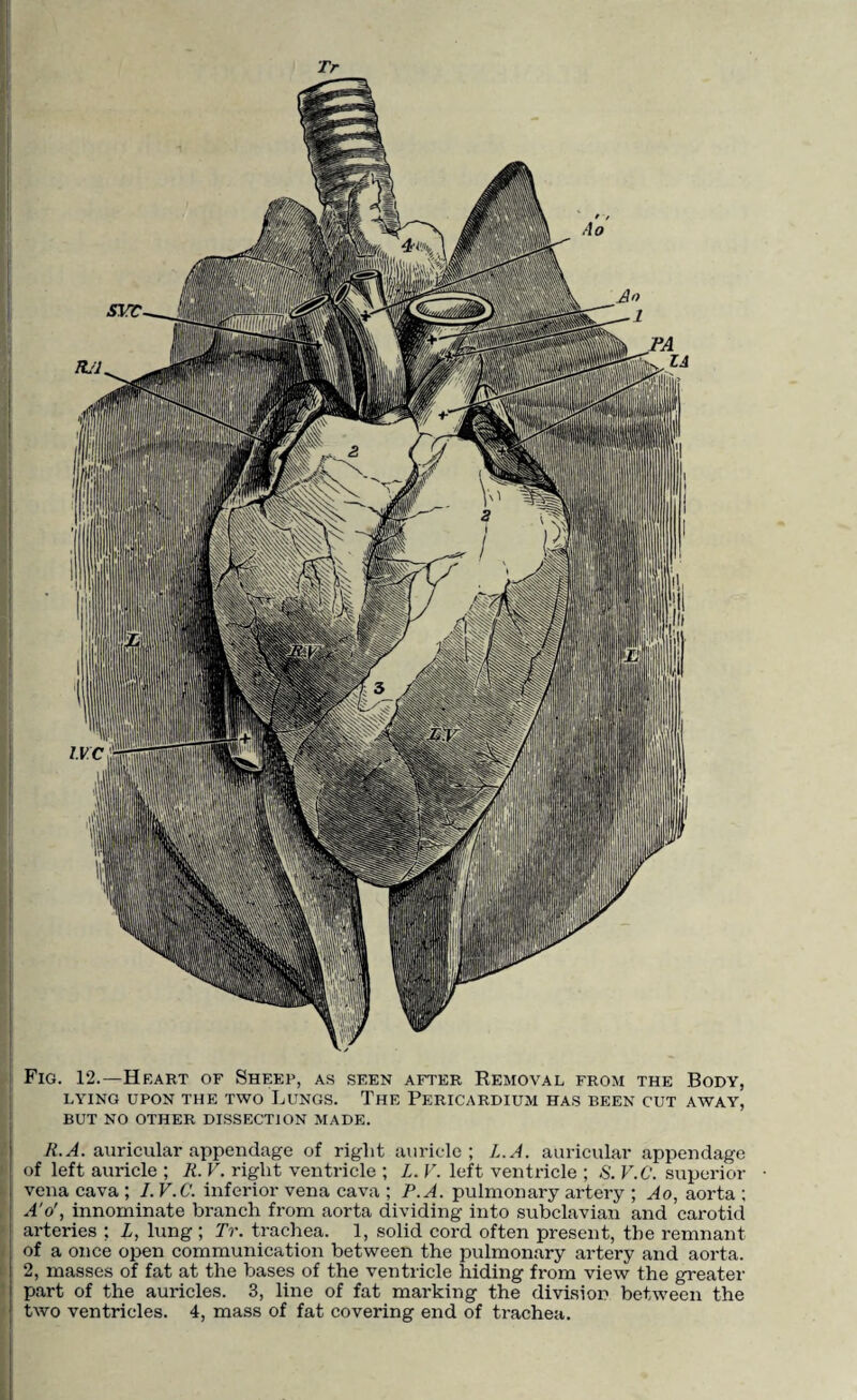 ! Tr Fig. 12.—Heart of Sheep, as seen after Removal from the Body, LYING UPON THE TWO LUNGS. THE PERICARDIUM HAS BEEN CUT AWAY, BUT NO OTHER DISSECTION MADE. R.A. auricular appendage of right auricle; L.A. auricular appendage | of left auricle ; R. V. right ventricle ; Z. V. left ventricle ; S. V.C. superior j vena cava ; I. V.C. inferior vena cava ; P.A. pulmonary artery ; Ao, aorta ; j A'o', innominate branch from aorta dividing into subclavian and carotid arteries ; Z, lung ; Tr. trachea. 1, solid cord often present, the remnant | of a once open communication between the pulmonary artery and aorta, j 2, masses of fat at the bases of the ventricle hiding from view the greater j part of the auricles. 3, line of fat marking the division between the | two ventricles. 4, mass of fat covering end of trachea.