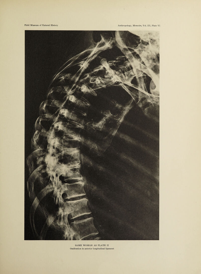 SAME WOMAN AS PLATE II Ossification in anterior longitudinal ligament