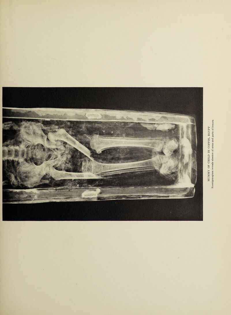 MUMMY OF CHILD IN COFFIN, EGYPT Roentgenogram reveals absence of arms and parts of femora