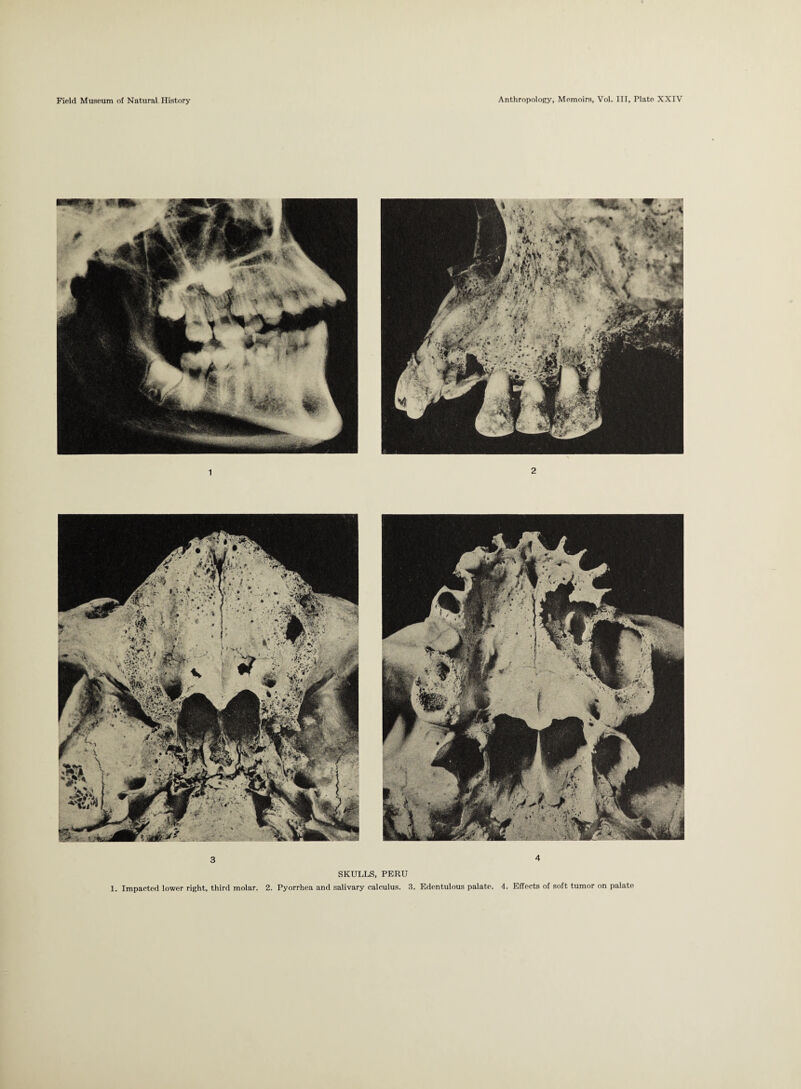 1 2 • * * ~ t.;i»i 3 4 SKULLS, PERU 1. Impacted lower right, third molar. 2. Pyorrhea and salivary calculus. 3. Edentulous palate. 4. Effects of soft tumor on palate