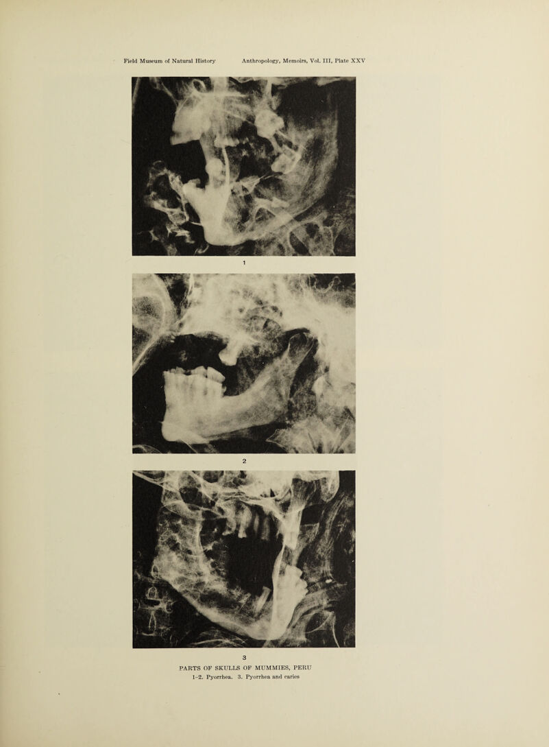 :V r ■Taw 4 ^ 3 PARTS OF SKULLS OF MUMMIES, PERU 1-2. Pyorrhea. 3. Pyorrhea and caries