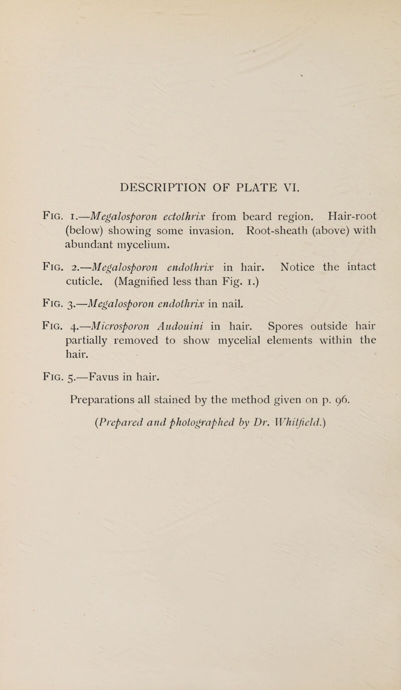 Fig. i.—Megalosporon edothrix from beard region. Hair-root (below) showing some invasion. Root-sheath (above) with abundant mycelium. Fig. 2.—Megalosporon endothrix in hair. Notice the intact cuticle. (Magnified less than Fig. i.) Fig. 3.—Megalosporon endothrix in nail. Fig. 4.—Microsporon Audouini in hair. Spores outside hair partially removed to show mycelial elements within the hair. Fig. 5.—Favus in hair. Preparations all stained by the method given on p. 96. (.Prepared and photographed by Dr. Whitfield.)