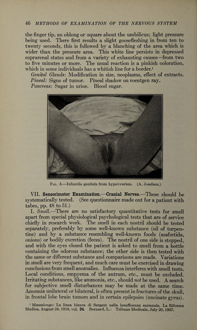 the finger tip, an oblong or square about the umbilicus; light pressure being used. There first results a slight goosefleshing in from ten to twenty seconds, this is followed by a blanching of the area which is wider than the pressure area. This white line persists in depressed suprarenal states and from a variety of exhausting causes—from two to five minutes or more. The usual reaction is a pinkish coloration, which in some individuals has a whitish line for a border.1 Genital Glands: Modification in size, neoplasms, effect of extracts. Pineal: Signs of tumor. Pineal shadow on roentgen ray. Pancreas: Sugar in urine. Blood sugar. Fig. 5.—Infantile genitals from hypoovarism. (A. Josefson.) VII. Sensorimotor Examination.—Cranial Nerves.—These should be systematically tested. (See questionnaire made out for a patient with tabes, pp. 48 to 51.) I. Smell.—There are no satisfactory quantitative tests for smell apart from special physiological psychological tests that are of service chiefly in research work. The smell in each nostril should be tested separately, preferably by some well-known substance (oil of turpen¬ tine) and by a substance resembling well-known foods (asafoetida, onions) or bodily excretion (feces). The nostril of one side is stopped, and with the eyes closed the patient is asked to smell from a bottle containing the odorous substance; the other side is then tested with the same or different substance and comparisons are made. Variations in smell are very frequent, and much care must be exercised in drawing conclusions from smell anomalies. Influenza interferes with smell tests. Local conditions, empyema of the antrum, etc., must be excluded. Irritating substances, like ammonia, etc., should not be used. A search for subjective smell disturbances may be made at the same time. Anosmia unilateral or bilateral, is often present in fractures of the skull, in frontal lobe brain tumors and in certain epilepsies (uncinate gyrus). 1 Massalongo: La linea bianca di Sergent nella insufficenza surrenale, La Riforma Medica, August 24. 1918, vol, 34. Bernard, L.: Tribune Medicale, July 20, 1907.