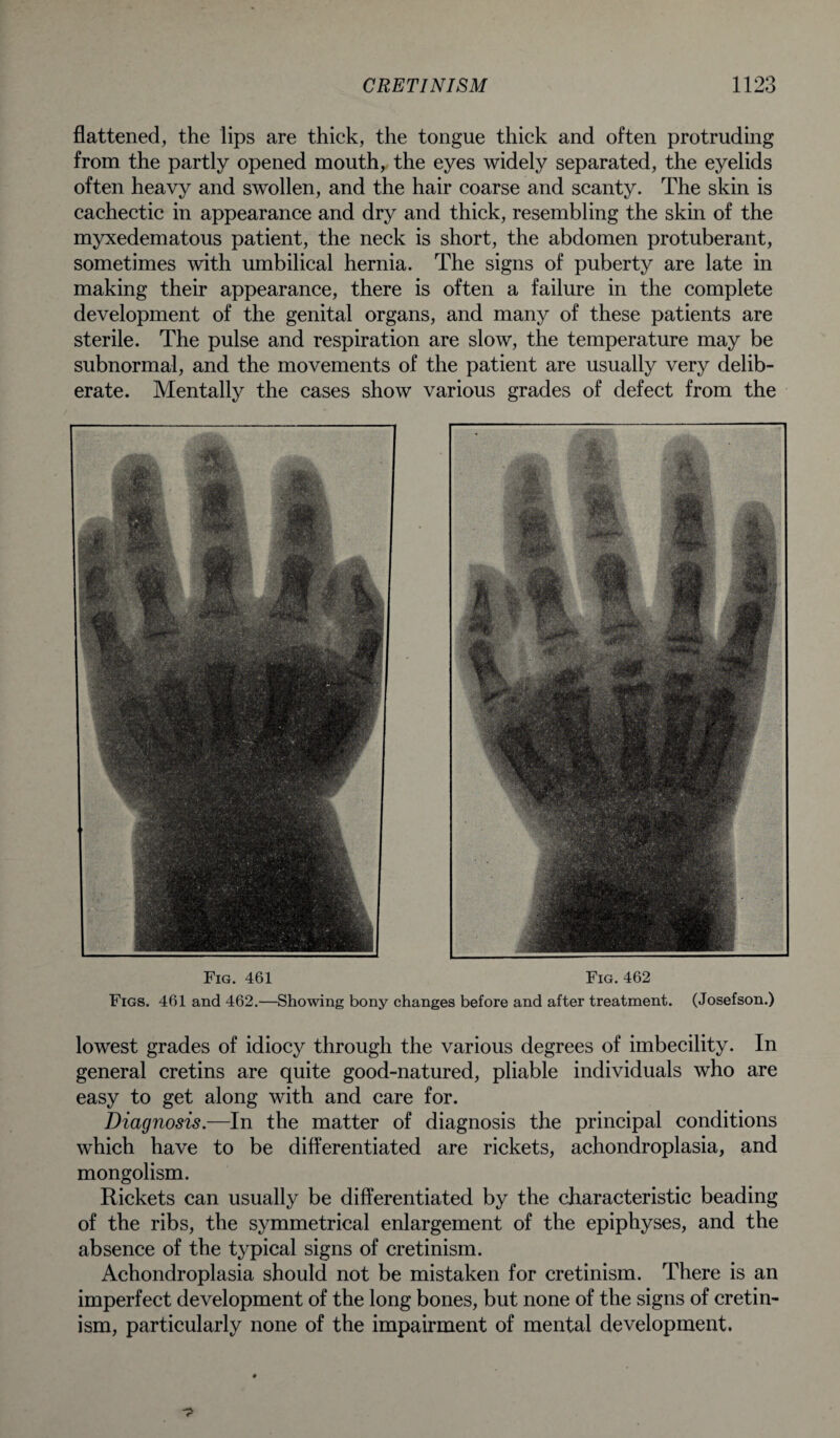 flattened, the lips are thick, the tongue thick and often protruding from the partly opened mouth, the eyes widely separated, the eyelids often heavy and swollen, and the hair coarse and scanty. The skin is cachectic in appearance and dry and thick, resembling the skin of the myxedematous patient, the neck is short, the abdomen protuberant, sometimes with umbilical hernia. The signs of puberty are late in making their appearance, there is often a failure in the complete development of the genital organs, and many of these patients are sterile. The pulse and respiration are slow, the temperature may be subnormal, and the movements of the patient are usually very delib¬ erate. Mentally the cases show various grades of defect from the Fig. 461 Fig. 462 Figs. 461 and 462.—Showing bony changes before and after treatment. (Josefson.) lowest grades of idiocy through the various degrees of imbecility. In general cretins are quite good-natured, pliable individuals who are easy to get along with and care for. Diagnosis.—In the matter of diagnosis the principal conditions which have to be differentiated are rickets, achondroplasia, and mongolism. Rickets can usually be differentiated by the characteristic beading of the ribs, the symmetrical enlargement of the epiphyses, and the absence of the typical signs of cretinism. Achondroplasia should not be mistaken for cretinism. There is an imperfect development of the long bones, but none of the signs of cretin¬ ism, particularly none of the impairment of mental development.