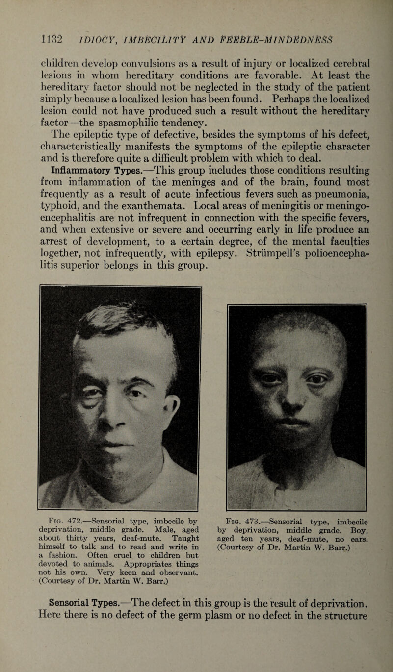 Fig. 472.—Sensorial type, imbecile by deprivation, middle grade. Male, aged about thirty years, deaf-mute. Taught himself to talk and to read and write in a fashion. Often cruel to children but devoted to animals. Appropriates things not his own. Very keen and observant. (Courtesy of Dr. Martin W. Barr.) Fig. 473.—Sensorial type, imbecile by deprivation, middle grade. Boy, aged ten years, deaf-mute, no ears. (Courtesy of Dr. Martin W. Barr.) Sensorial Types.—The defect in this group is the result of deprivation. Here there is no defect of the germ plasm or no defect in the structure 1132 IDIOCY, IMBECILITY AND FEEBLE-MINDEDNESS children develop convulsions as a result of injury or localized cerebral lesions in whom hereditary conditions are favorable. At least the hereditary factor should not be neglected in the study of the patient simply because a localized lesion has been found. Perhaps the localized lesion could not have produced such a result without the hereditary factor—the spasmophilic tendency. The epileptic type of defective, besides the symptoms of his defect, characteristically manifests the symptoms of the epileptic character and is therefore quite a difficult problem with which to deal. Inflammatory Types.—This group includes those conditions resulting from inflammation of the meninges and of the brain, found most frequently as a result of acute infectious fevers such as pneumonia, typhoid, and the exanthemata. Local areas of meningitis or meningo¬ encephalitis are not infrequent in connection with the specific fevers, and when extensive or severe and occurring early in life produce an arrest of development, to a certain degree, of the mental faculties logether, not infrequently, with epilepsy. StriimpeH’s polioencepha¬ litis superior belongs in this group.