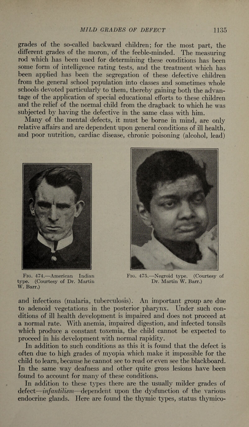 grades of the so-called backward children; for the most part, the different grades of the moron, of the feeble-minded. The measuring rod which has been used for determining these conditions has been some form of intelligence rating tests, and the treatment which has been applied has been the segregation of these defective children from the general school population into classes and sometimes whole schools devoted particularly to them, thereby gaining both the advan¬ tage of the application of special educational efforts to these children and the relief of the normal child from the dragback to which he was subjected by having the defective in the same class with him. Many of the mental defects, it must be borne in mind, are only relative affairs and are dependent upon general conditions of ill health, and poor nutrition, cardiac disease, chronic poisoning (alcohol, lead) Fig. 474.—American Indian Fig. 475.—Negroid type. (Courtesy of type. (Courtesy of Dr. Martin Dr. Martin W. Barr.) W. Barr.) and infections (malaria, tuberculosis). An important group are due to adenoid vegetations in the posterior pharynx. Under such con¬ ditions of ill health development is impaired and does not proceed at a normal rate. With anemia, impaired digestion, and infected tonsils which produce a constant toxemia, the child cannot be expected to proceed in his development with normal rapidity. In addition to such conditions as this it is found that the defect is often due to high grades of myopia which make it impossible for the child to learn, because he cannot see to read or even see the blackboard. In the same way deafness and other quite gross lesions have been found to account for many of these conditions. In addition to these types there are the usually milder grades of defect—infantilism—dependent upon the dysfunction of the various endocrine glands. Here are found the thymic types, status thymico-