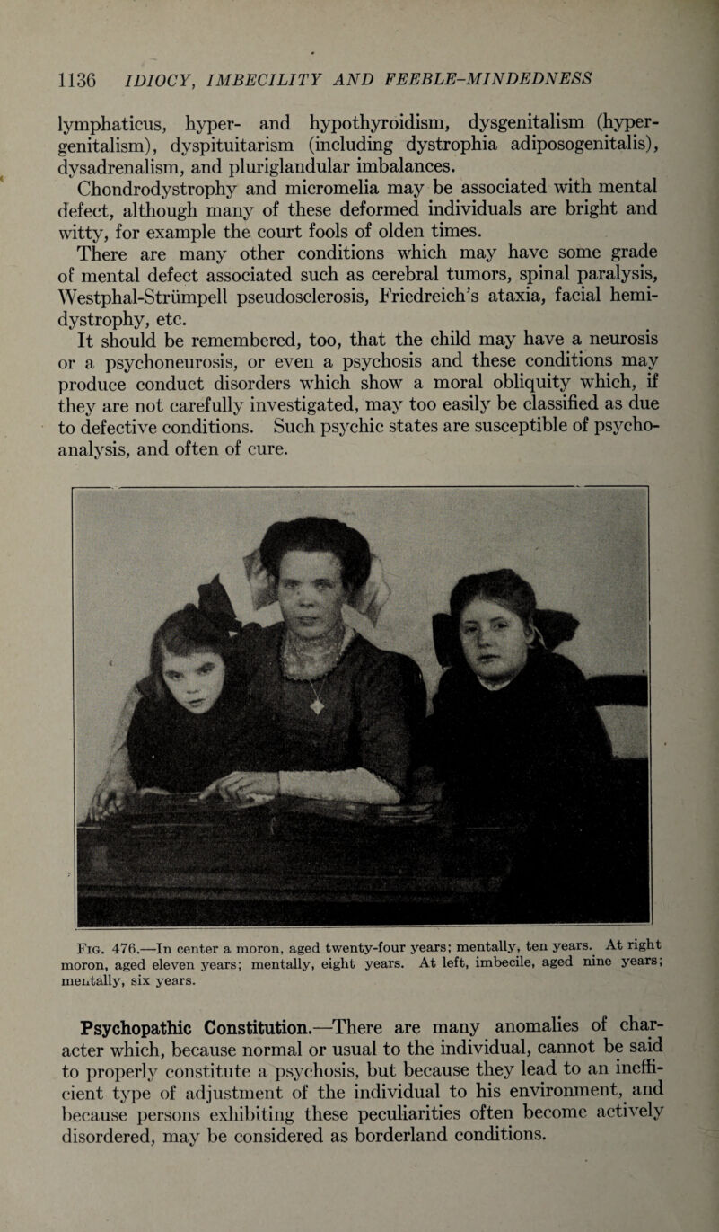 lymphaticus, hyper- and hypothyroidism, dysgenitalism (hyper- genitalism), dyspituitarism (including dystrophia adiposogenitalis), dysadrenalism, and pluriglandular imbalances. Chondrodystrophy and micromelia may be associated with mental defect, although many of these deformed individuals are bright and witty, for example the court fools of olden times. There are many other conditions which may have some grade of mental defect associated such as cerebral tumors, spinal paralysis, Westphal-Striimpell pseudosclerosis, Friedreich’s ataxia, facial hemi- dystrophy, etc. It should be remembered, too, that the child may have a neurosis or a psychoneurosis, or even a psychosis and these conditions may produce conduct disorders which show a moral obliquity which, if they are not carefully investigated, may too easily be classified as due to defective conditions. Such psychic states are susceptible of psycho¬ analysis, and often of cure. Fig. 476.—In center a moron, aged twenty-four years; mentally, ten years. At right moron, aged eleven years; mentally, eight years. At left, imbecile, aged nine years; mentally, six years. Psychopathic Constitution.—There are many anomalies of char¬ acter which, because normal or usual to the individual, cannot be said to properly constitute a psychosis, but because they lead to an ineffi¬ cient type of adjustment of the individual to his environment, and because persons exhibiting these peculiarities often become actively disordered, may be considered as borderland conditions.