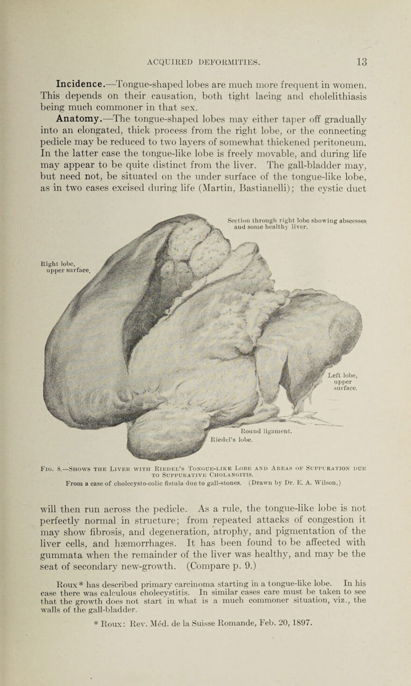 Incidence.—Tongue-shaped lobes are much more frequent in women. This depends on their causation, both tight lacing and cholelithiasis being much commoner in that sex. Anatomy.—-The tongue-shaped lobes may either taper off gradually into an elongated, thick process from the right lobe, or the connecting- pedicle may be reduced to two layers of somewhat thickened peritoneum. In the latter case the tongue-like lobe is freely movable, and during life may appear to be quite distinct from the liver. The gall-bladder may, but need not, be situated on the under surface of the tongue-like lobe, as in two cases excised during life (Martin, Bastianelli); the cystic duct Fig. 8.—Shows the Liver with Riedel’s Tongue-like Lobe and Areas of Suppuration due to Suppurative Cholangitis. From a case of cholecysto-colic fistula due to gall-stones. (Drawn by Dr. E. A. Wilson.) will then run across the pedicle. As a rule, the tongue-like lobe is not perfectly normal in structure; from repeated attacks of congestion it may show fibrosis, and degeneration, atrophy, and pigmentation of the liver cells, and haemorrhages. It has been found to be affected with gummata when the remainder of the liver was healthy, and may be the seat of secondary new-growth. (Compare p. 9.) Roux * has described primary carcinoma starting in a tongue-like lobe. In his case there was calculous cholecystitis. In similar cases care must be taken to see that the growth does not start in what is a much commoner situation, viz., the walls of the gall-bladder. * Roux: Rev. Med. de la Suisse Romande, Feb. 20, 1897.